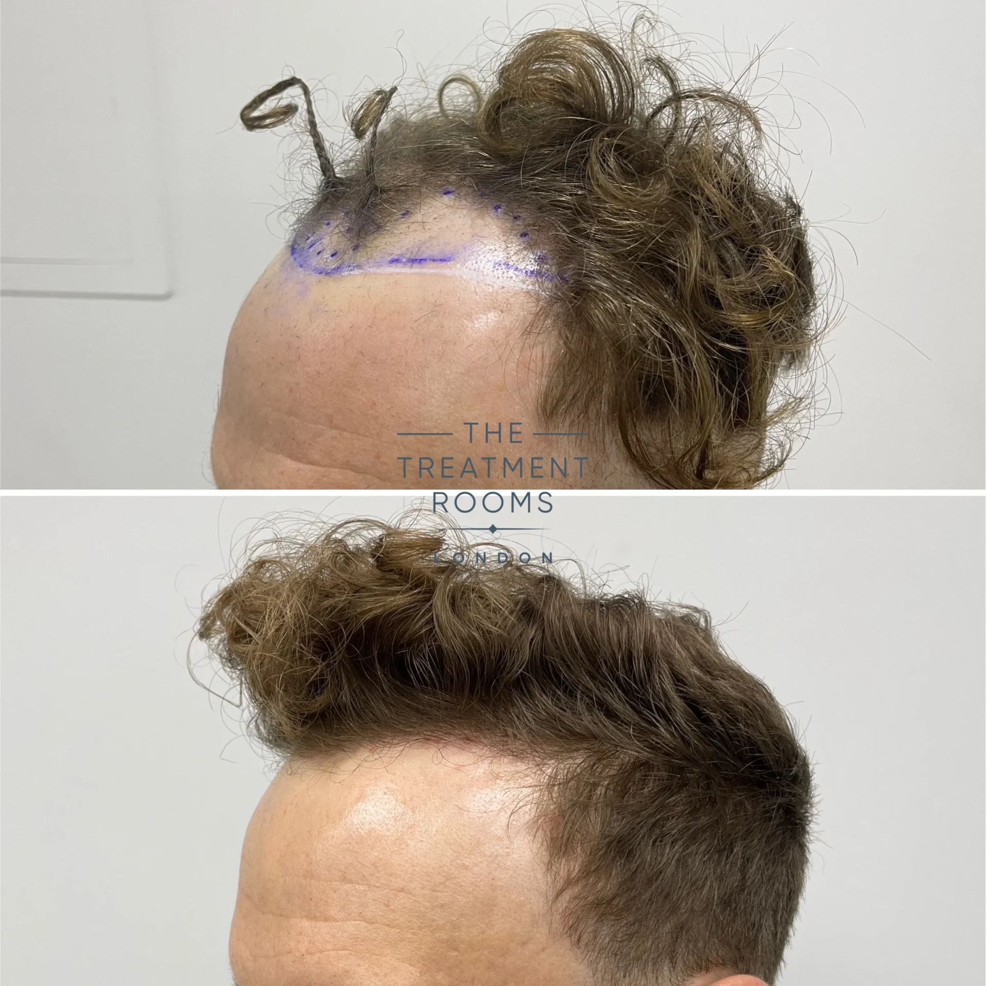best hairline transplant clinic london 1514 grafts before and after