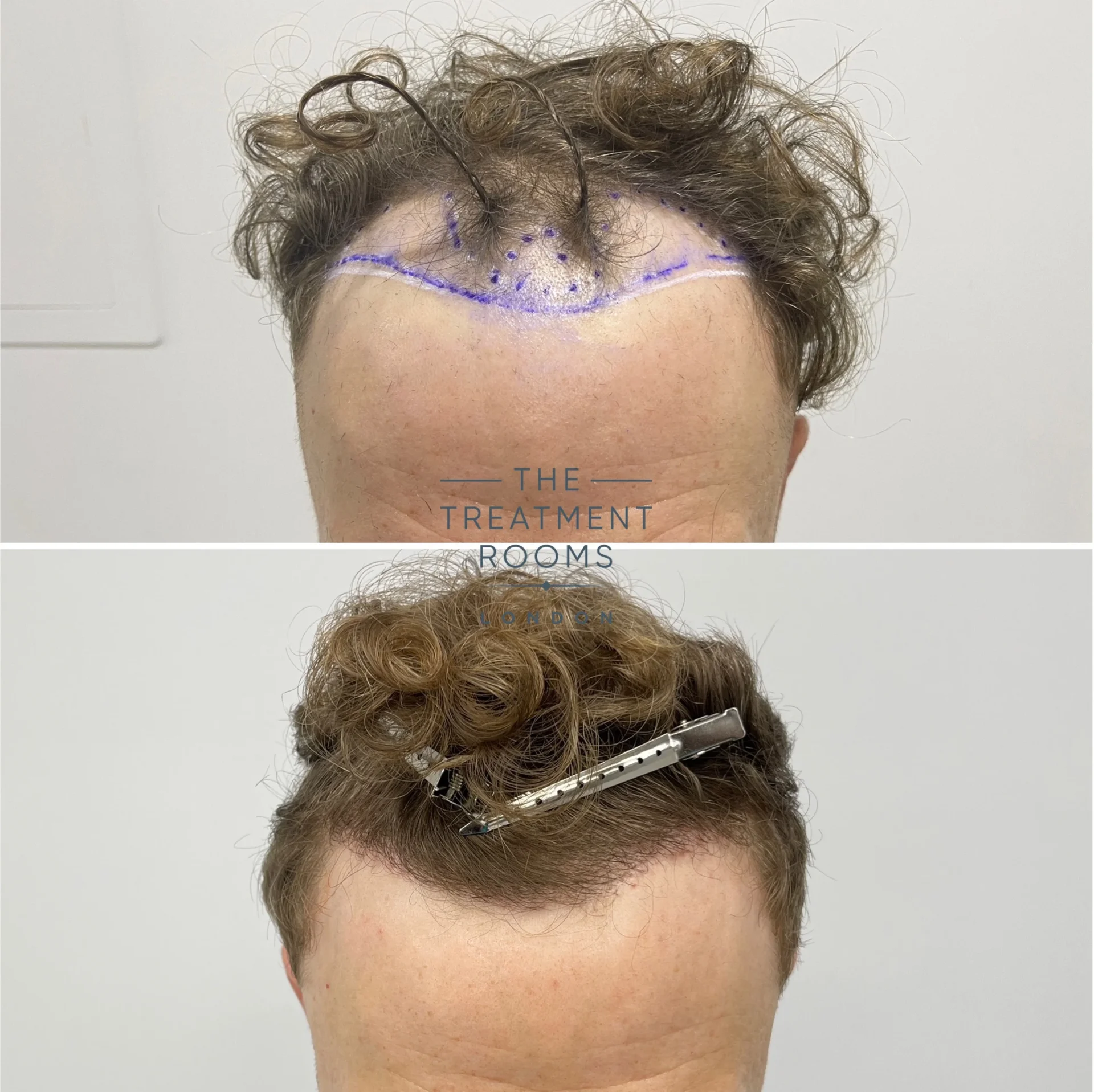best receding hairline transplant clinic london 1514 grafts before and after