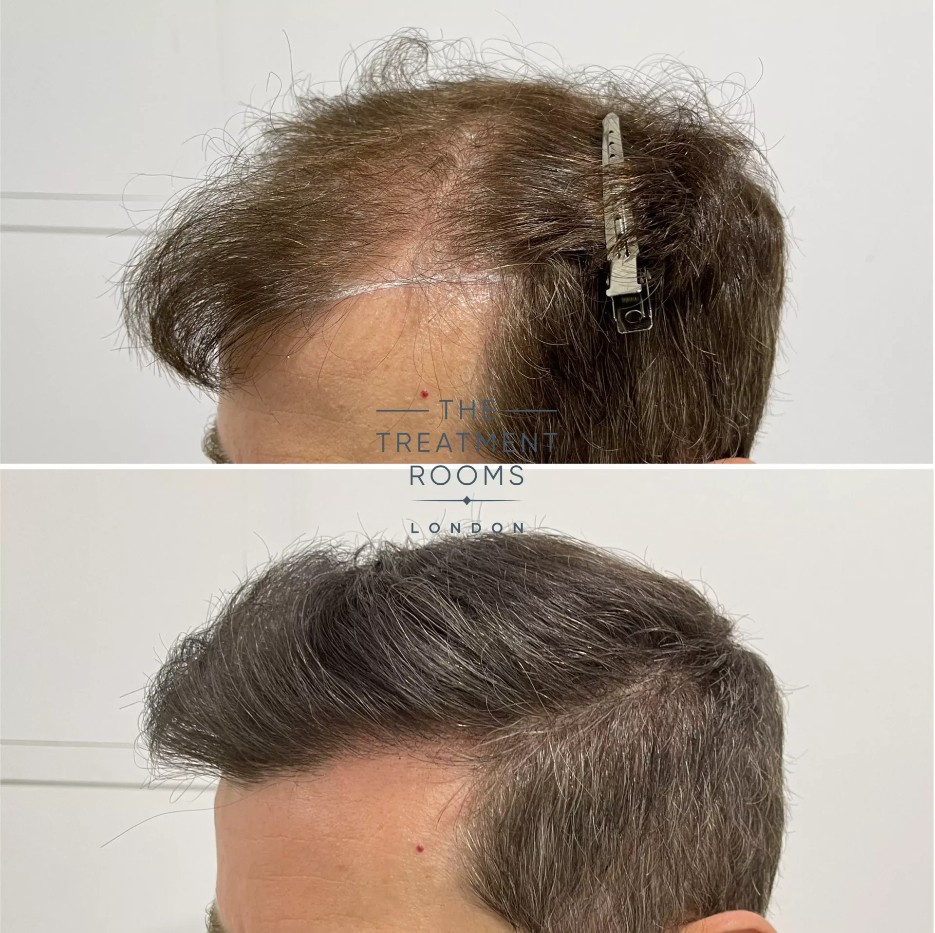 best reviewed hair transplant clinic 1491 grafts before and after