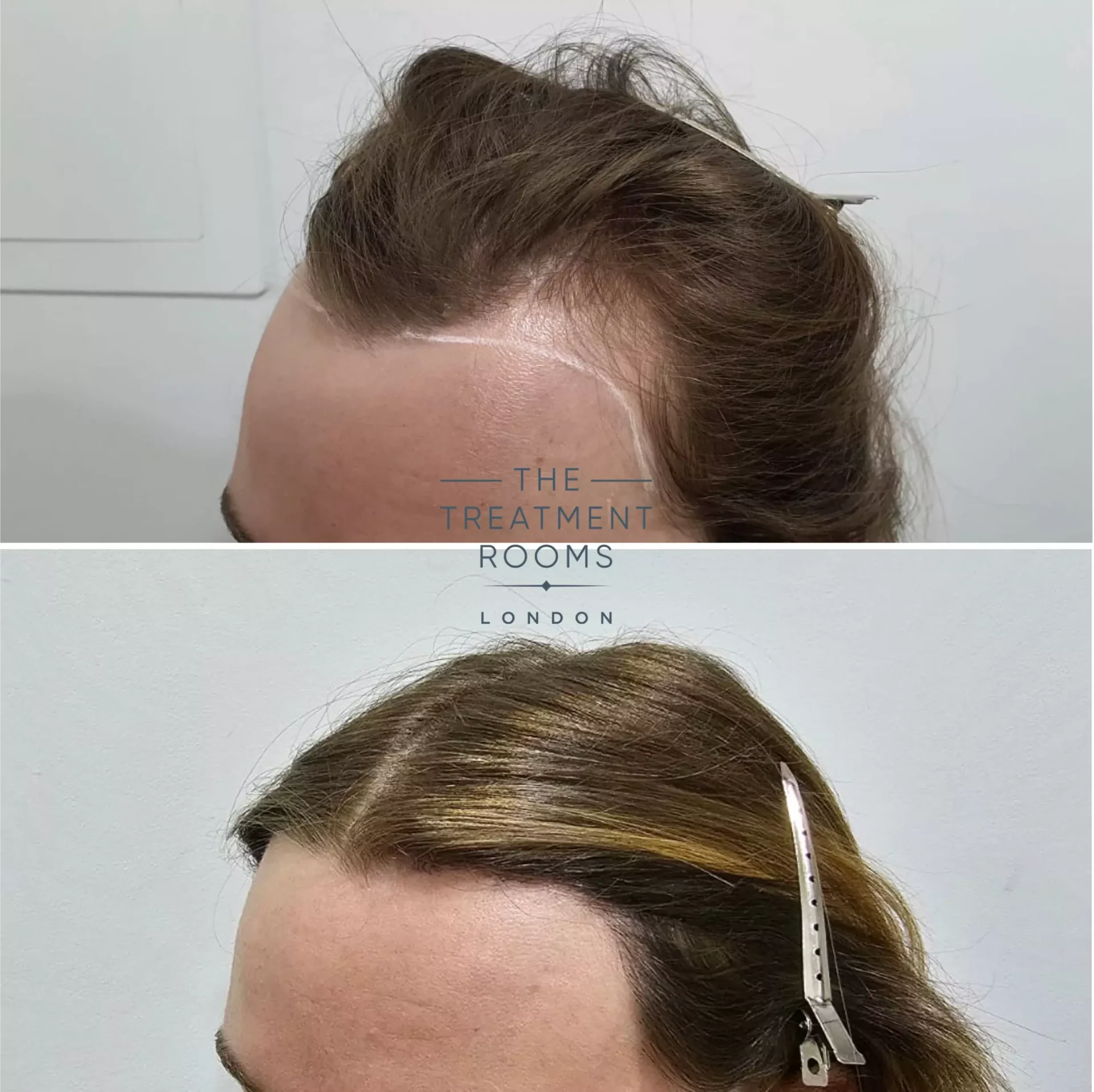best transgender hair transplant clinic 1553 grafts before and after