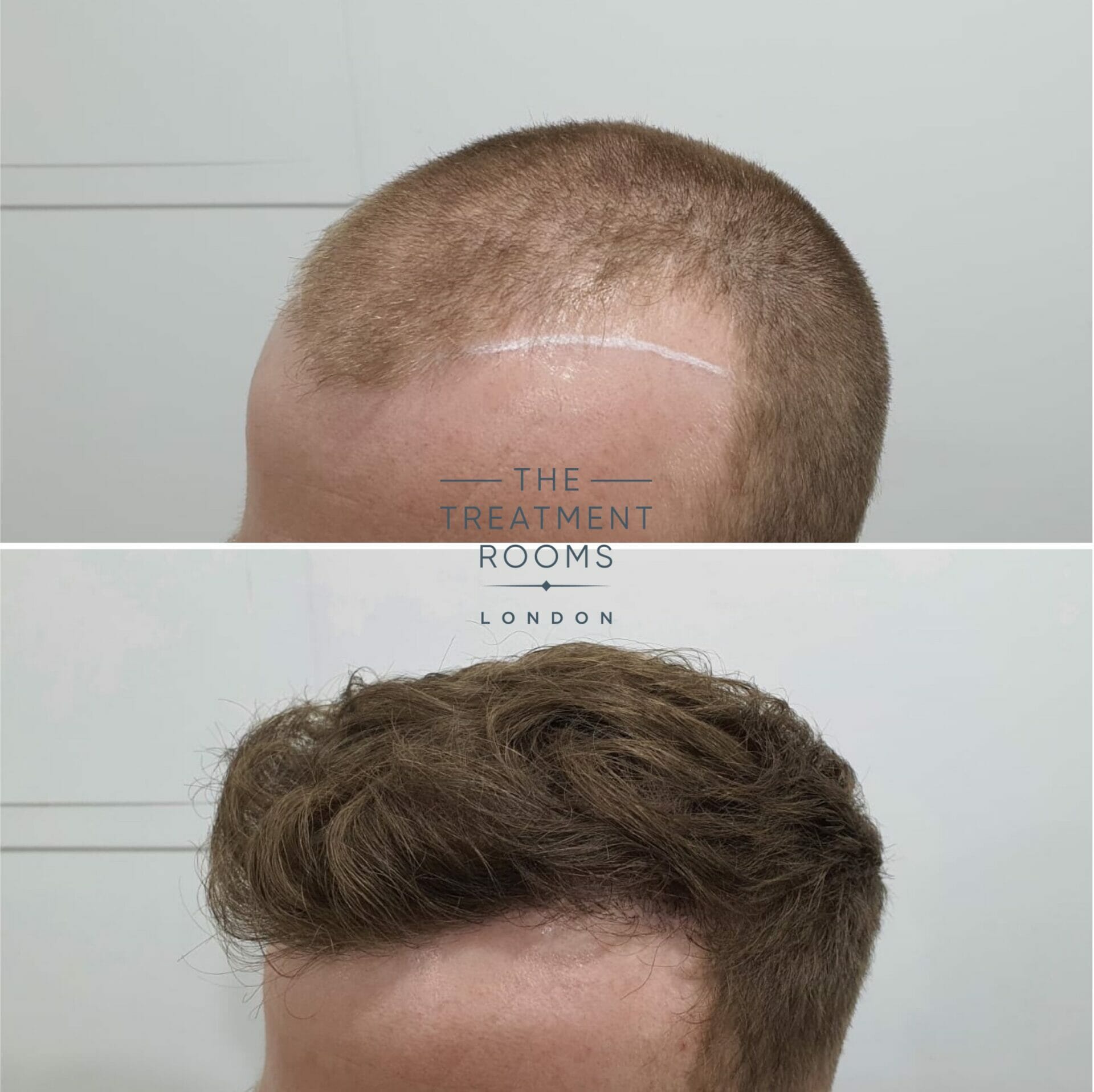 best weather for hair transplant