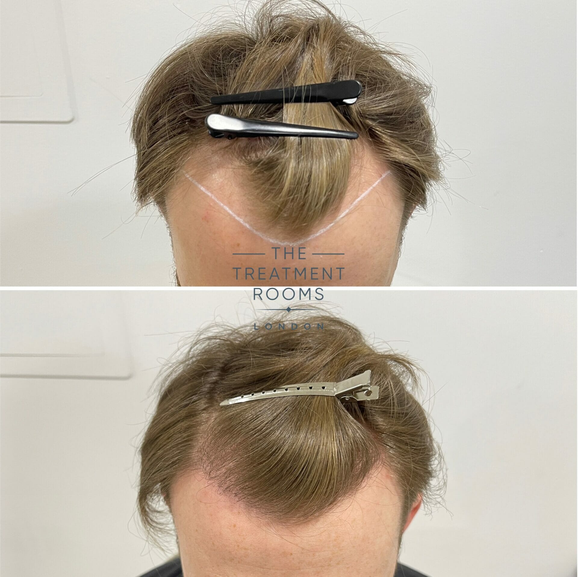 blonde hair fue hair transplant before and after 1700 grafts