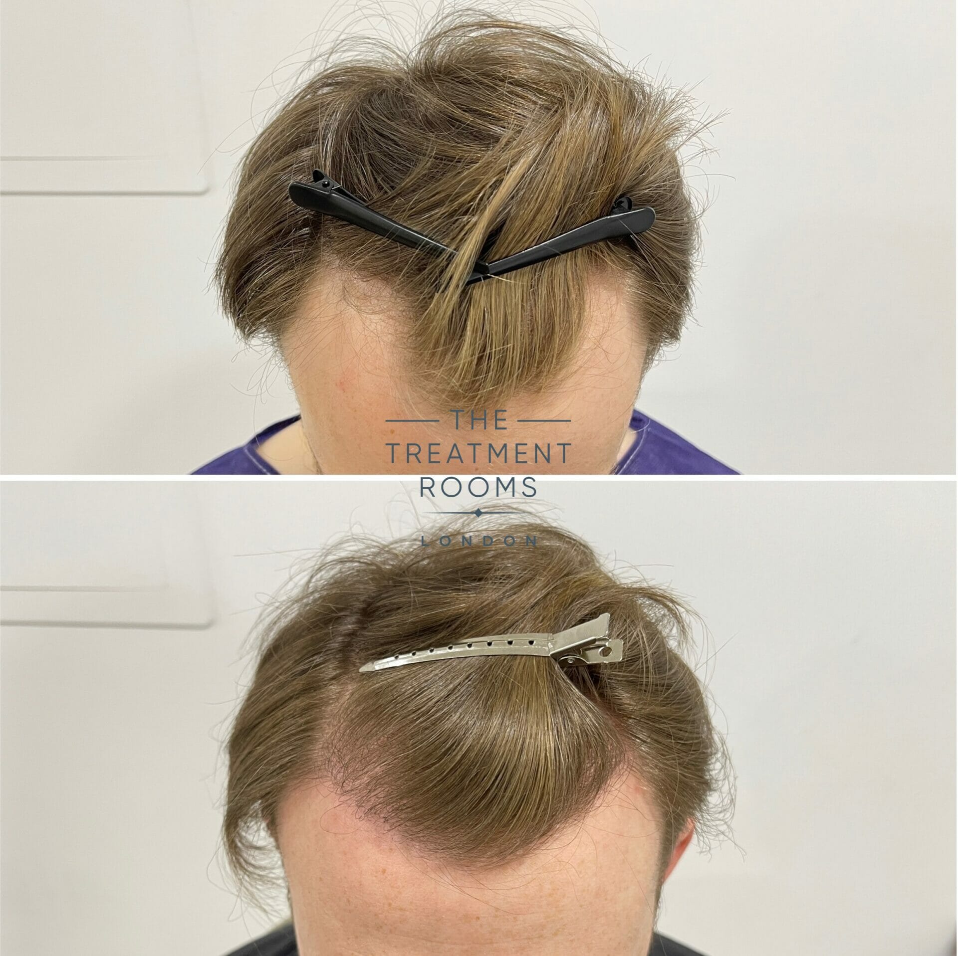 Hair Transplant Before and After 1700 grafts - Treatment Rooms London