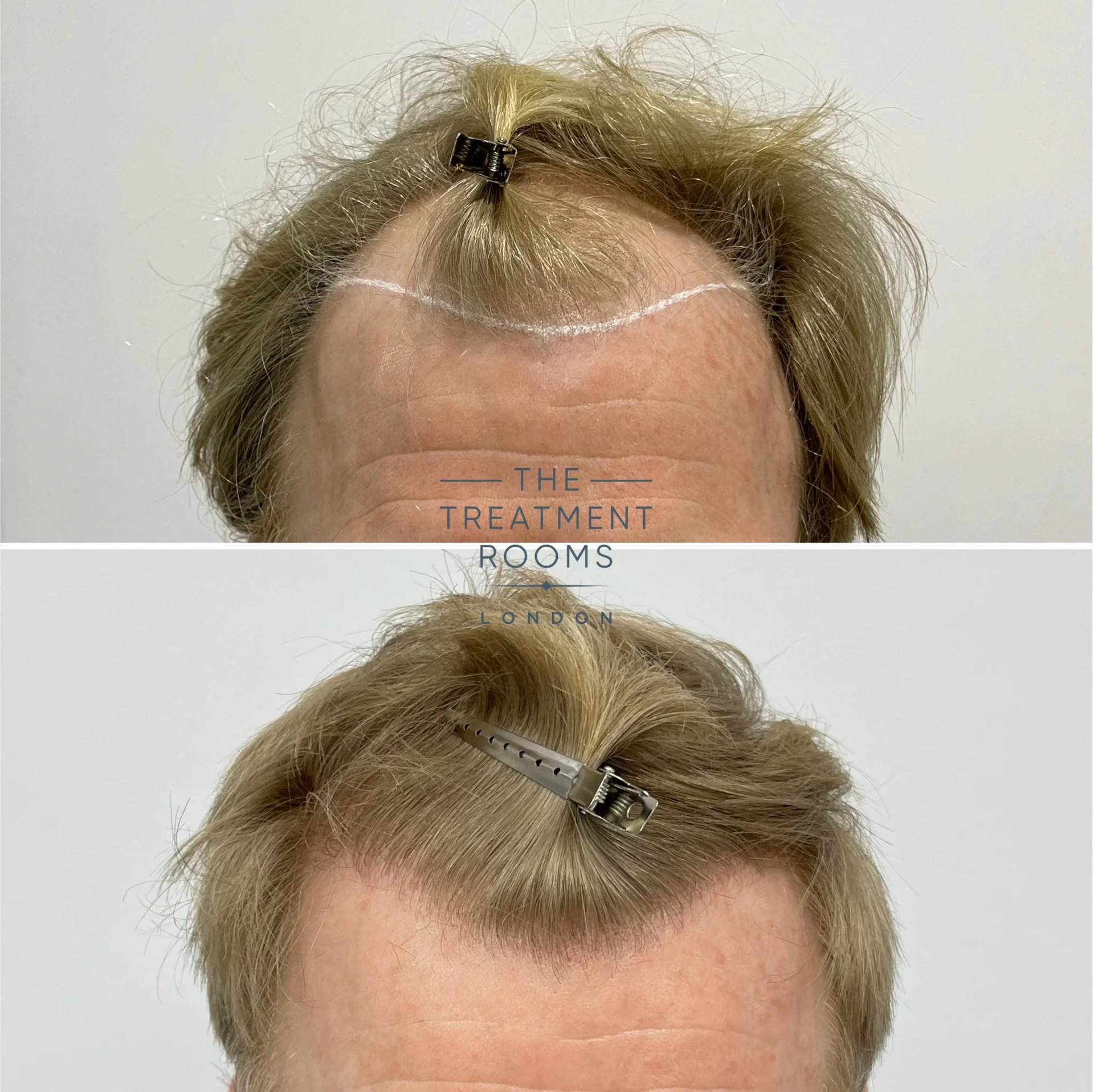 blonde hair transplant london 2087 grafts before and after