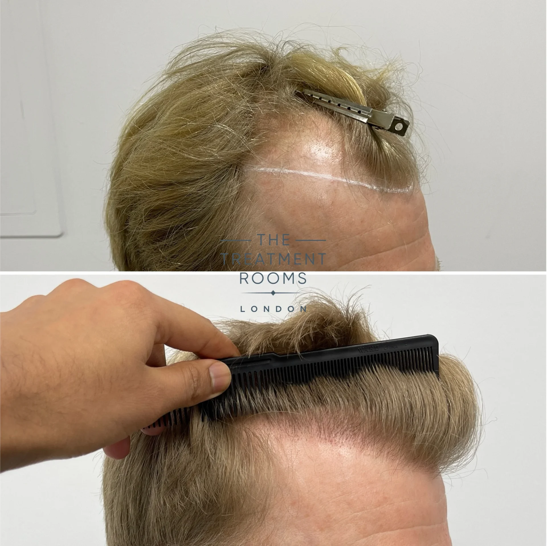 blonde hairline transplant london 2087 grafts