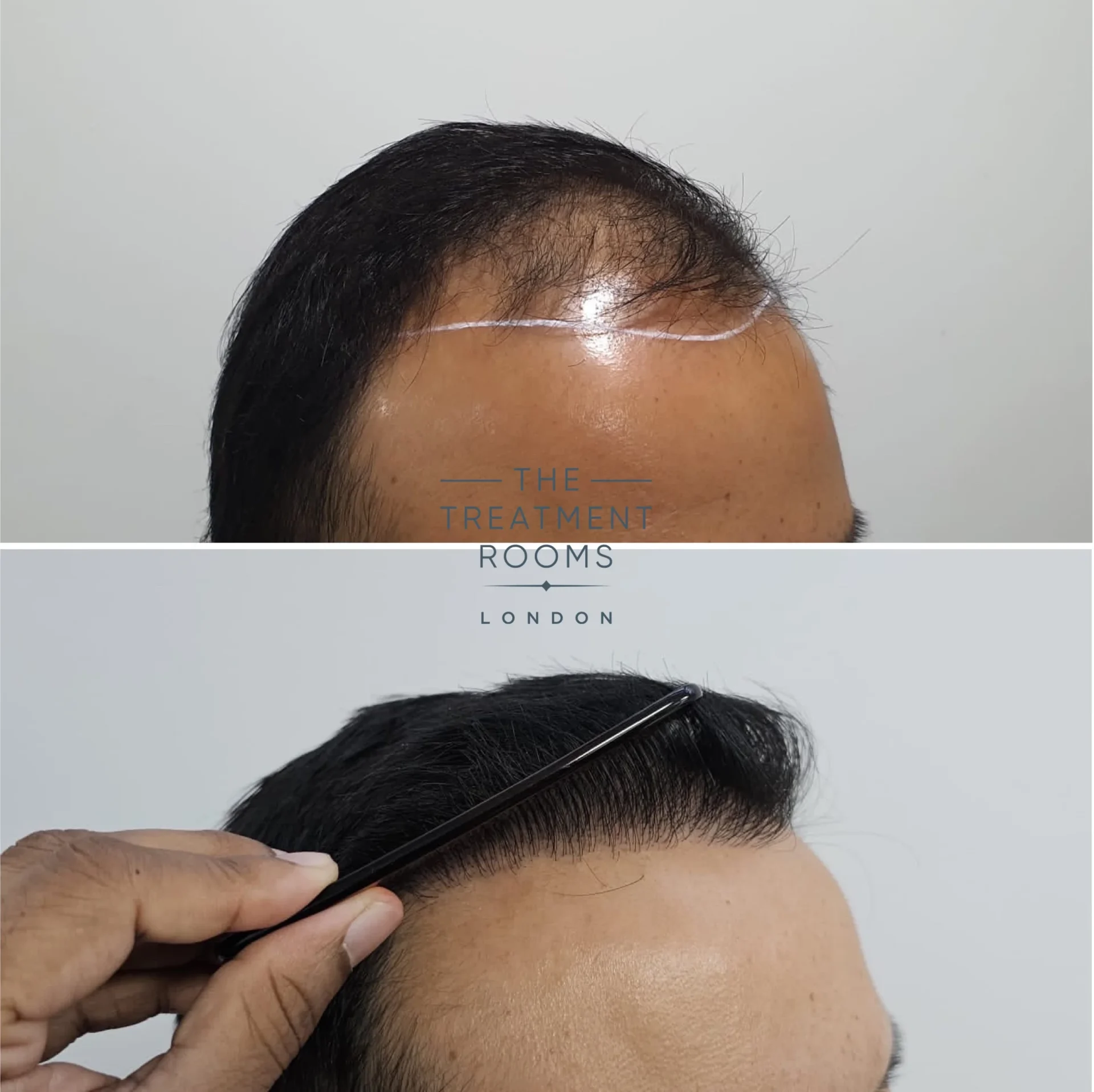 chinese fue hair transplant result 2036 grafts