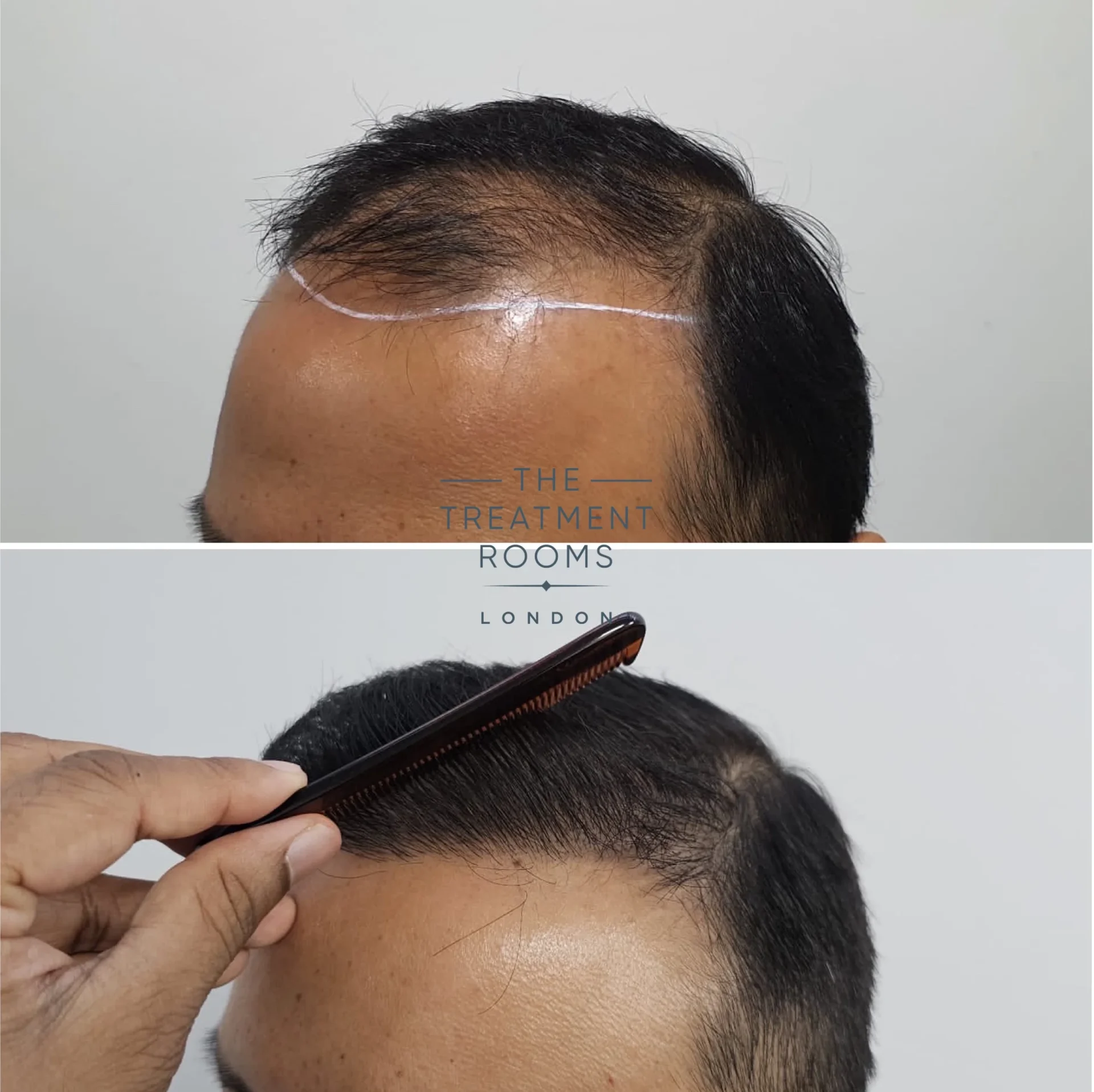 chinese hair transplant result 2036 grafts result