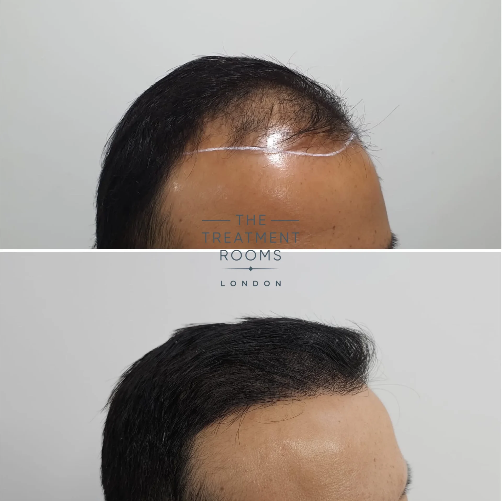 chinese hair transplant result 2036 grafts