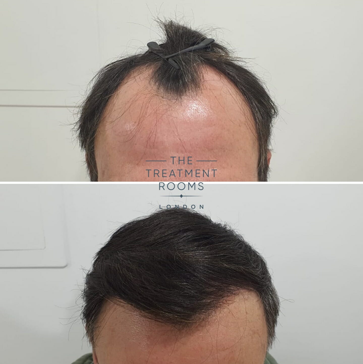 cost for receding hairline transplant