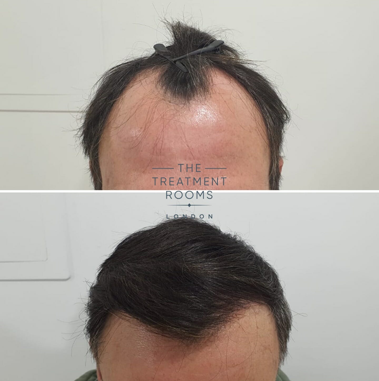 How much does a receding hairline transplant cost?