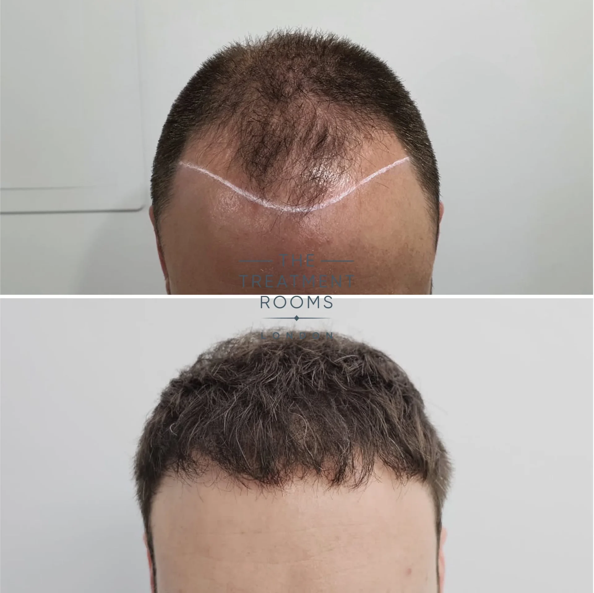 crown and hairline 3299 grafts before and after fue hair transplant