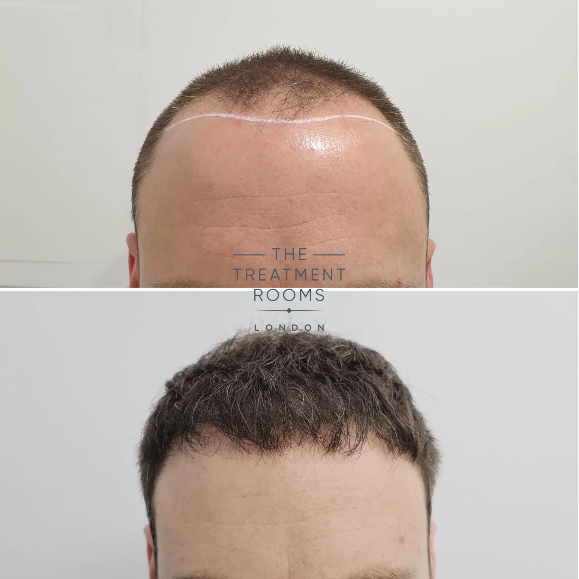 FUE Hair Transplant Result 3299 grafts Treatment Rooms London