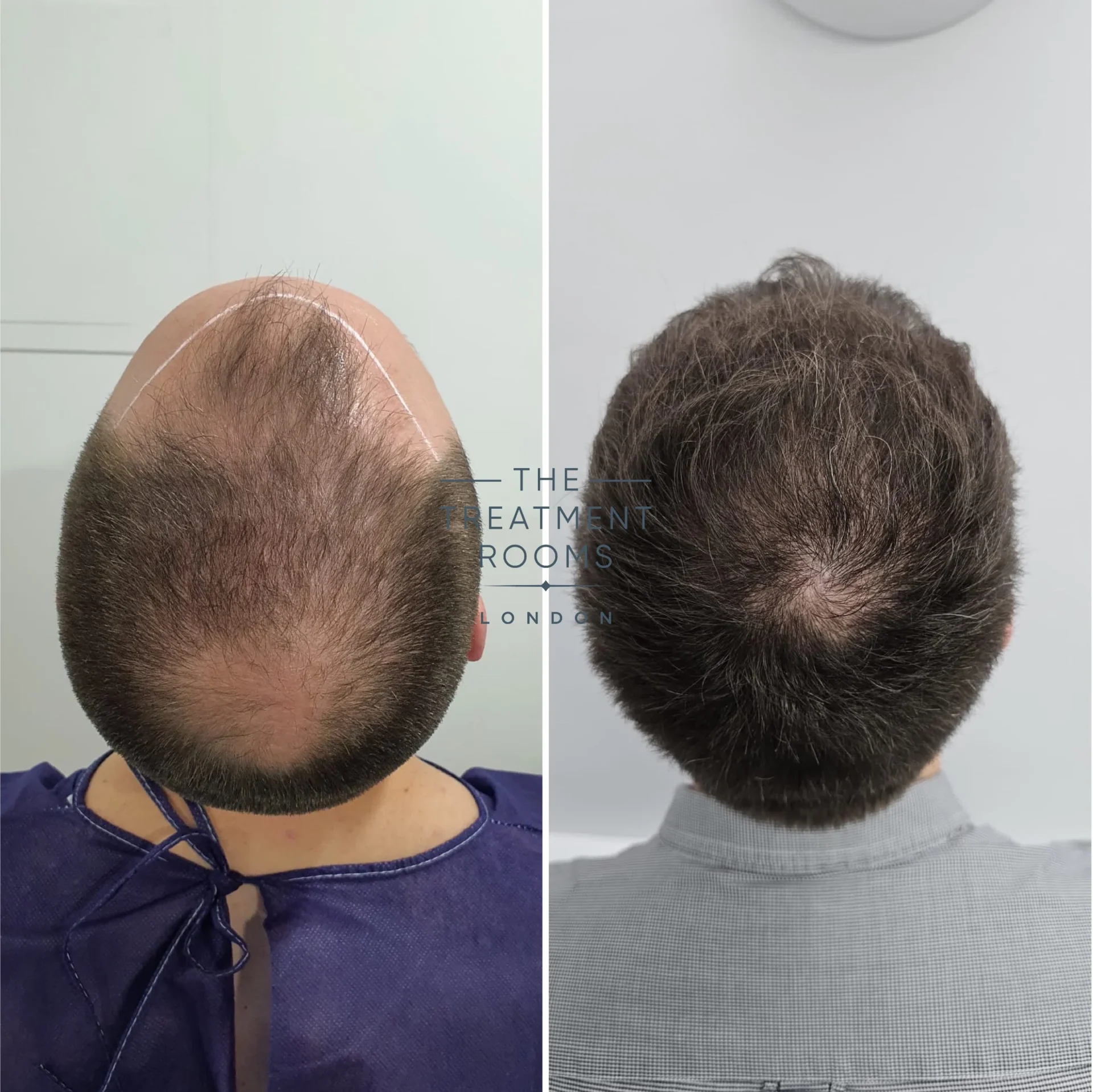 crown and hairline 3299 grafts before and after hair transplant