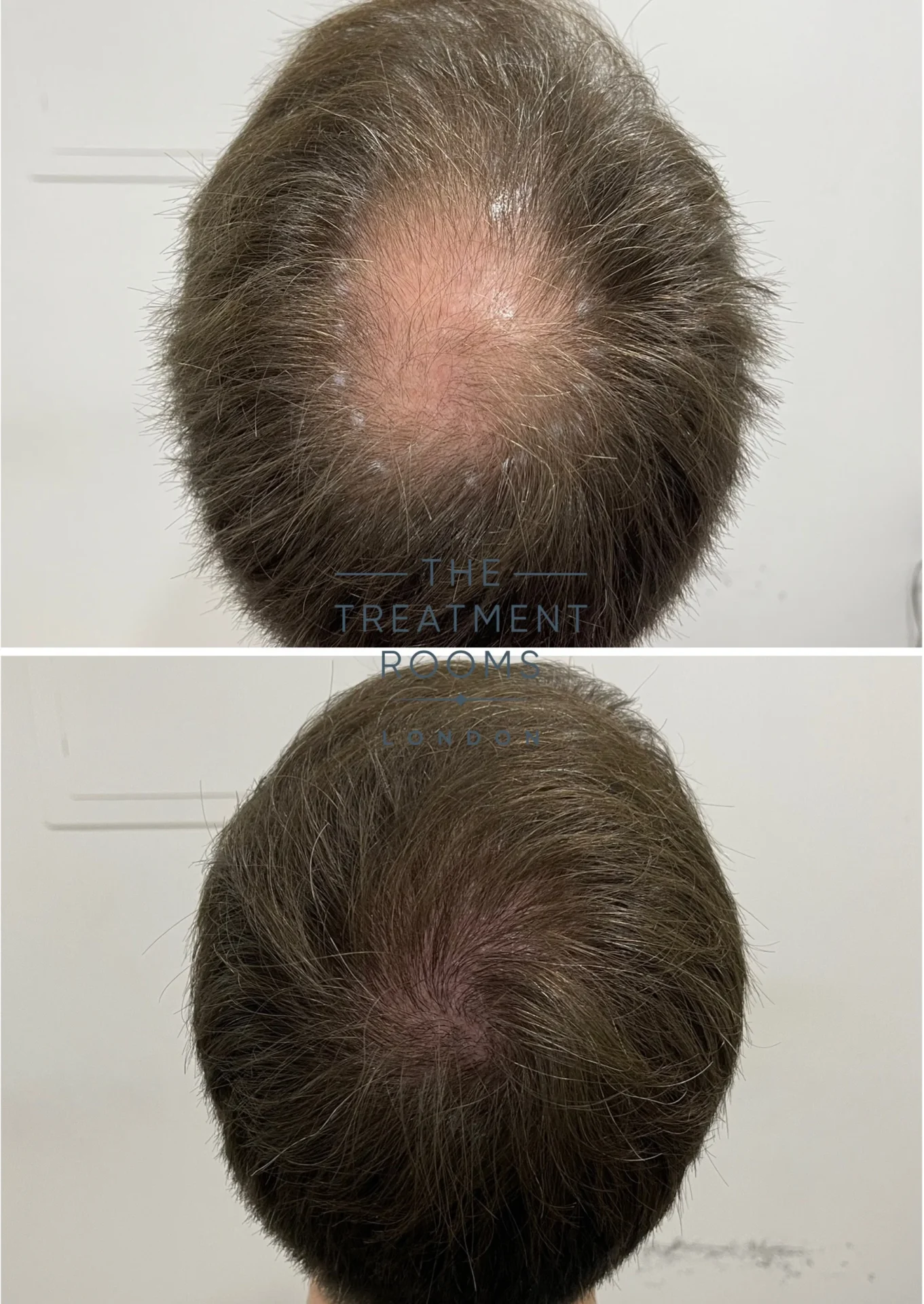 crown fue hair transplant 1485 grafts before and after
