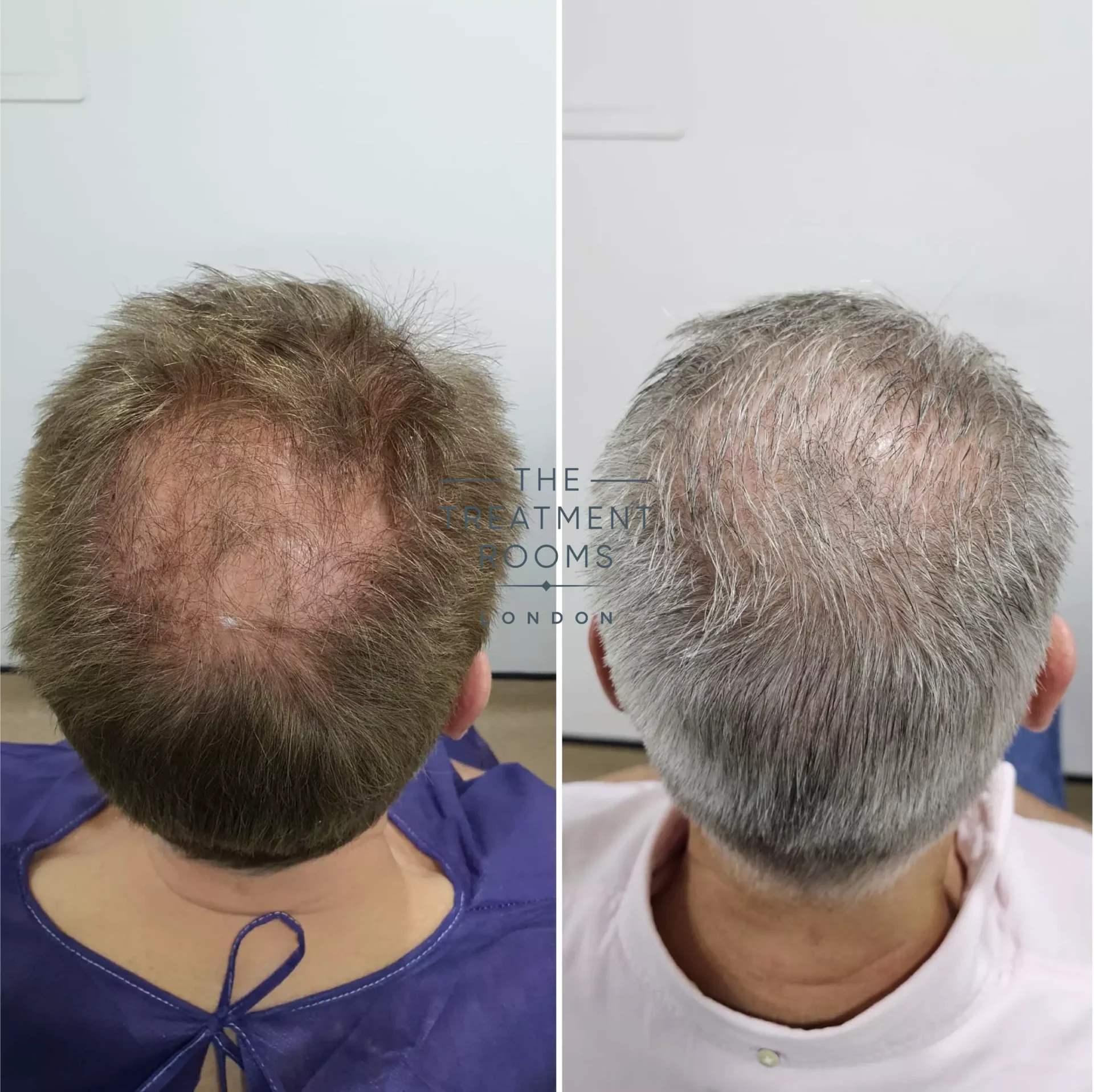 crown fue hair transplant before and after 2126 grafts