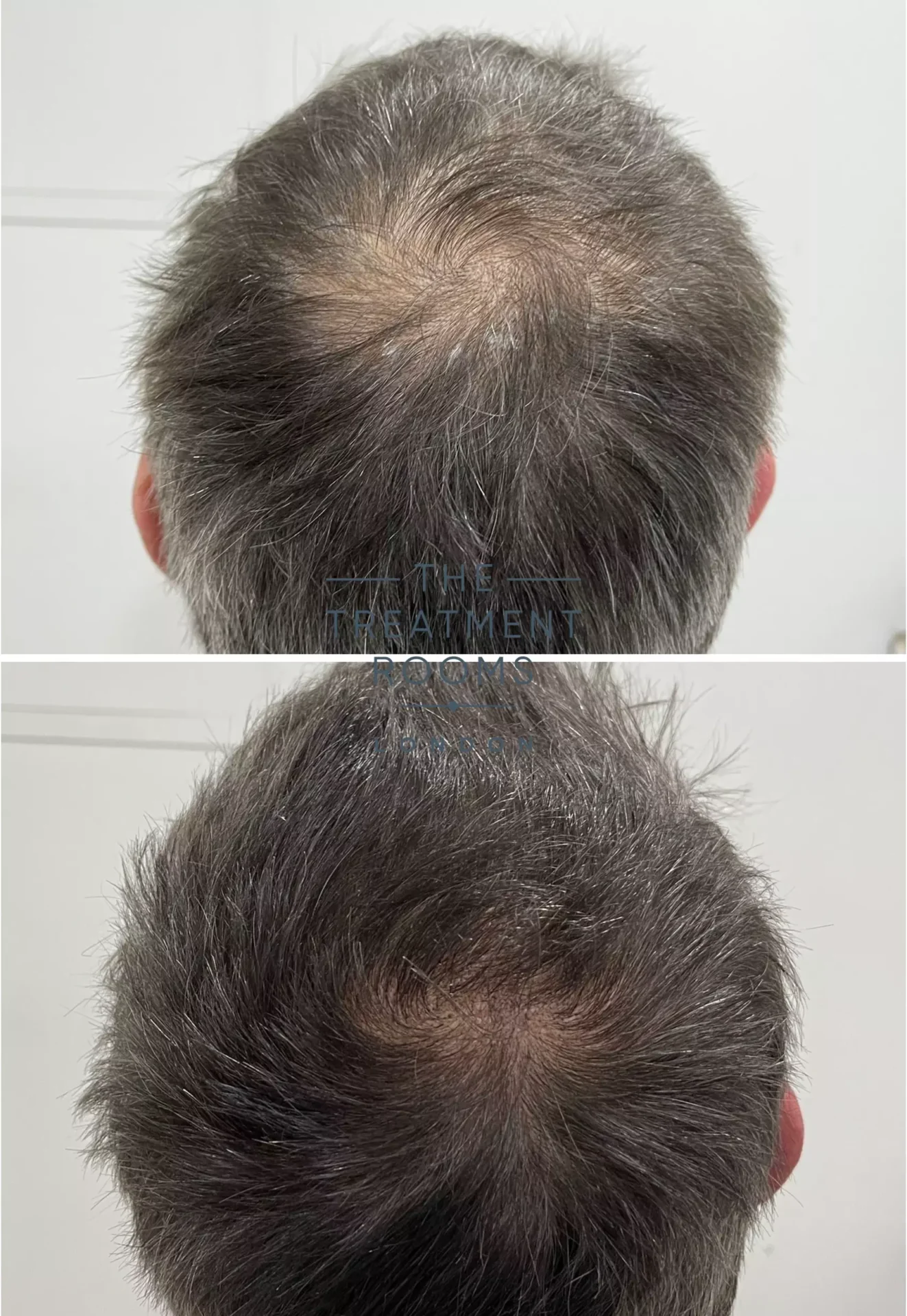 crown fue hair transplant before and after 597 grafts