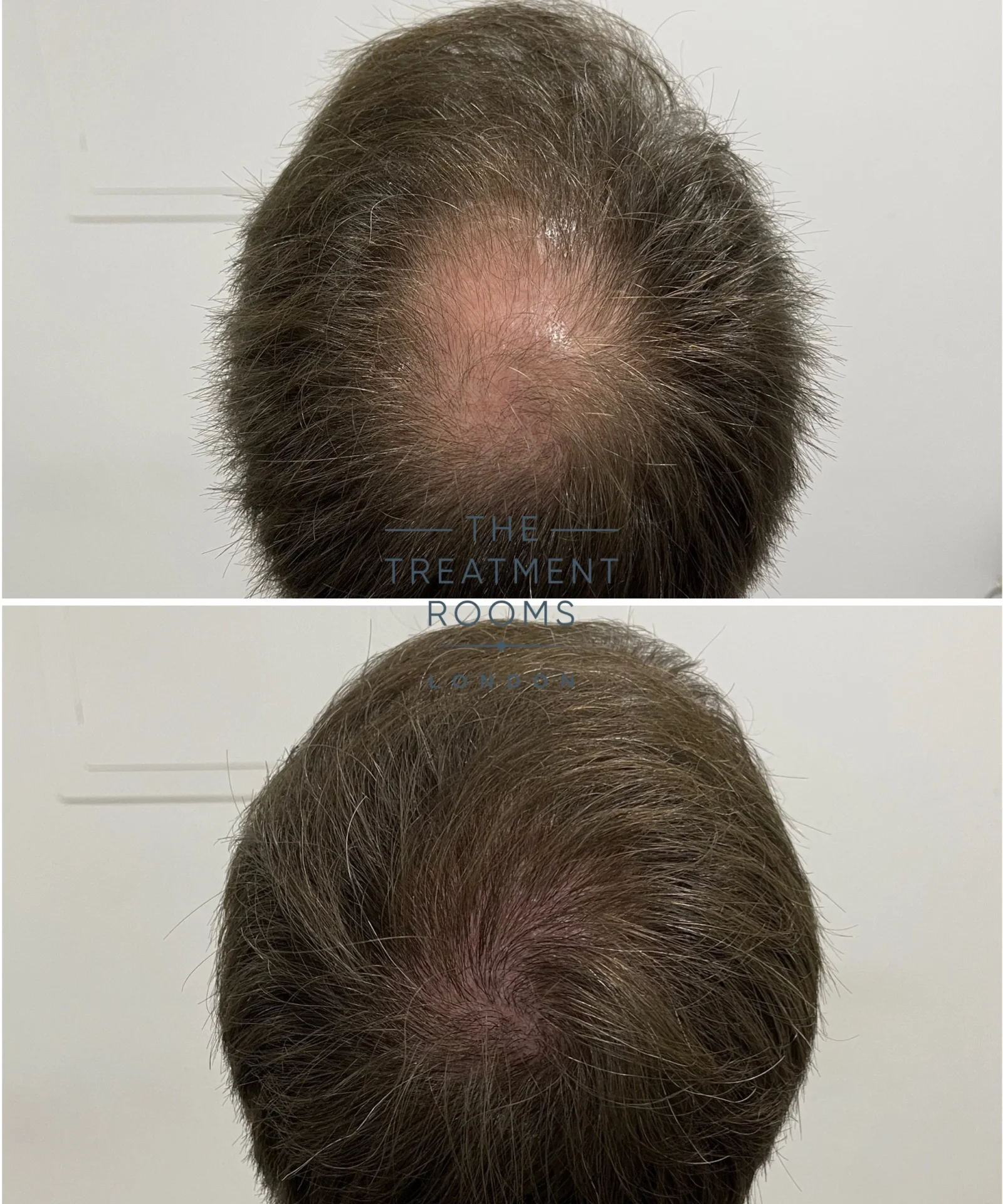 crown fue hair transplant london 1485 grafts before and after