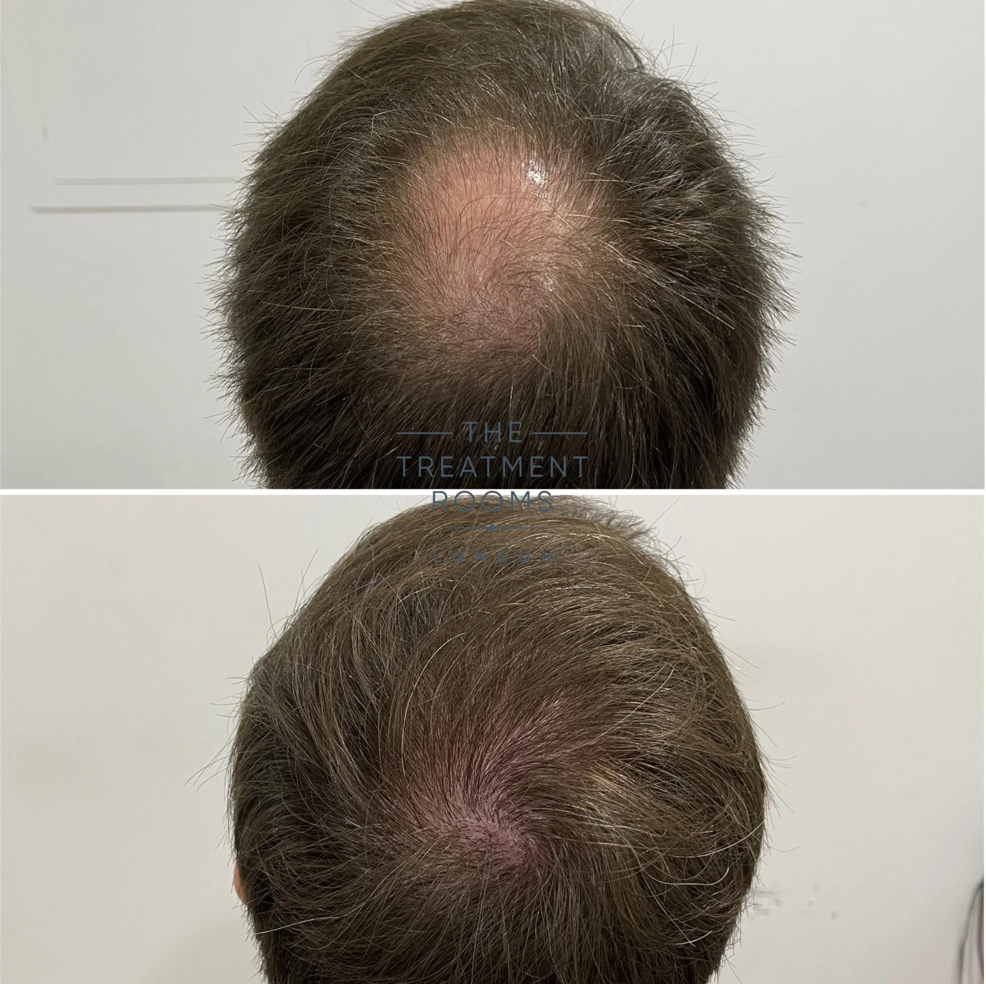 crown hair transplant 1485 grafts before and after