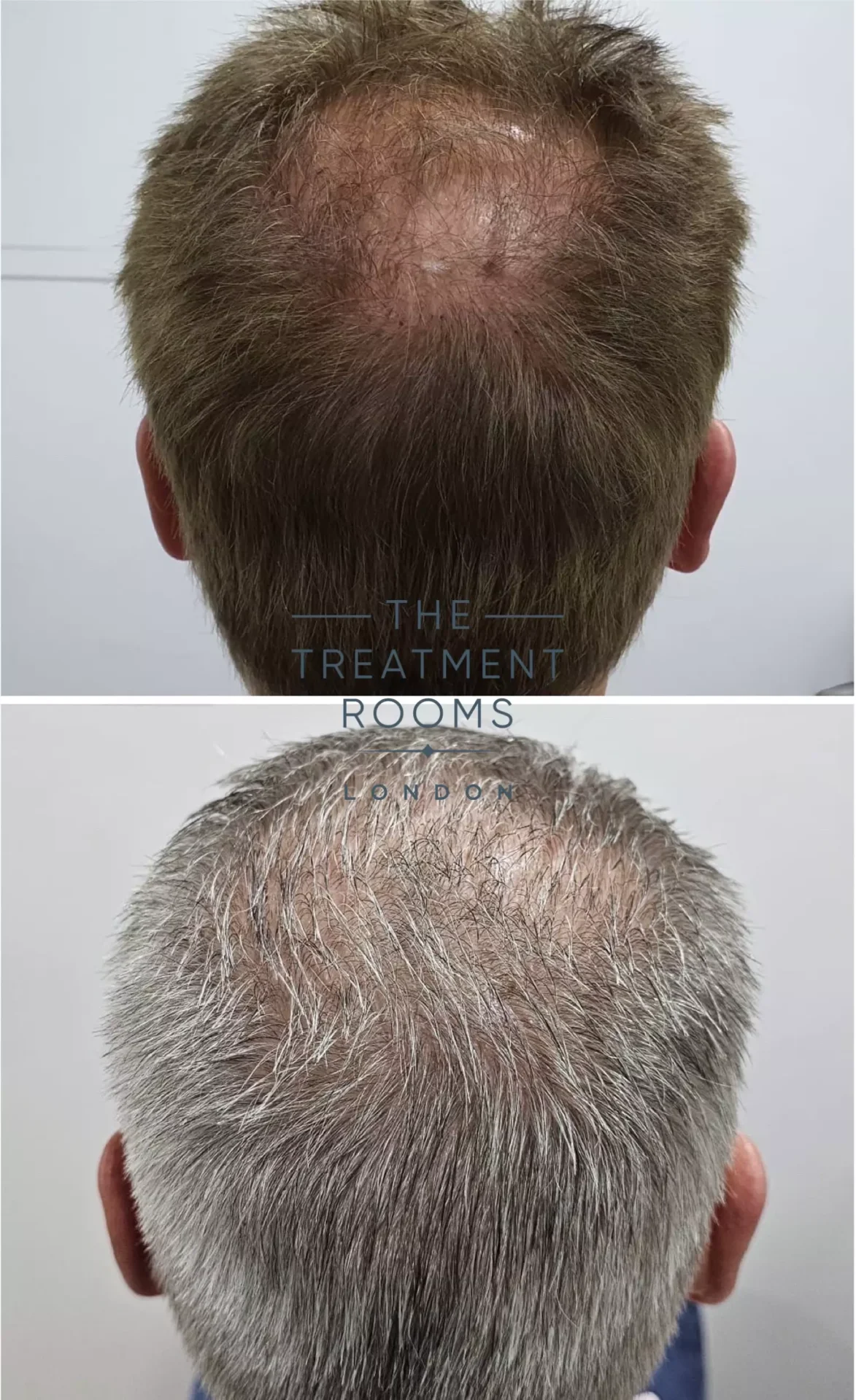 crown hair transplant before and after