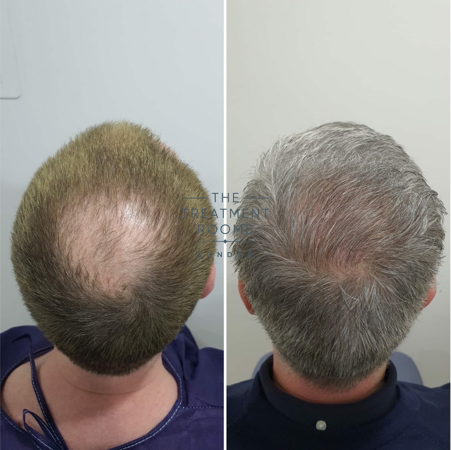 crown hair transplant before and after 2322 grafts