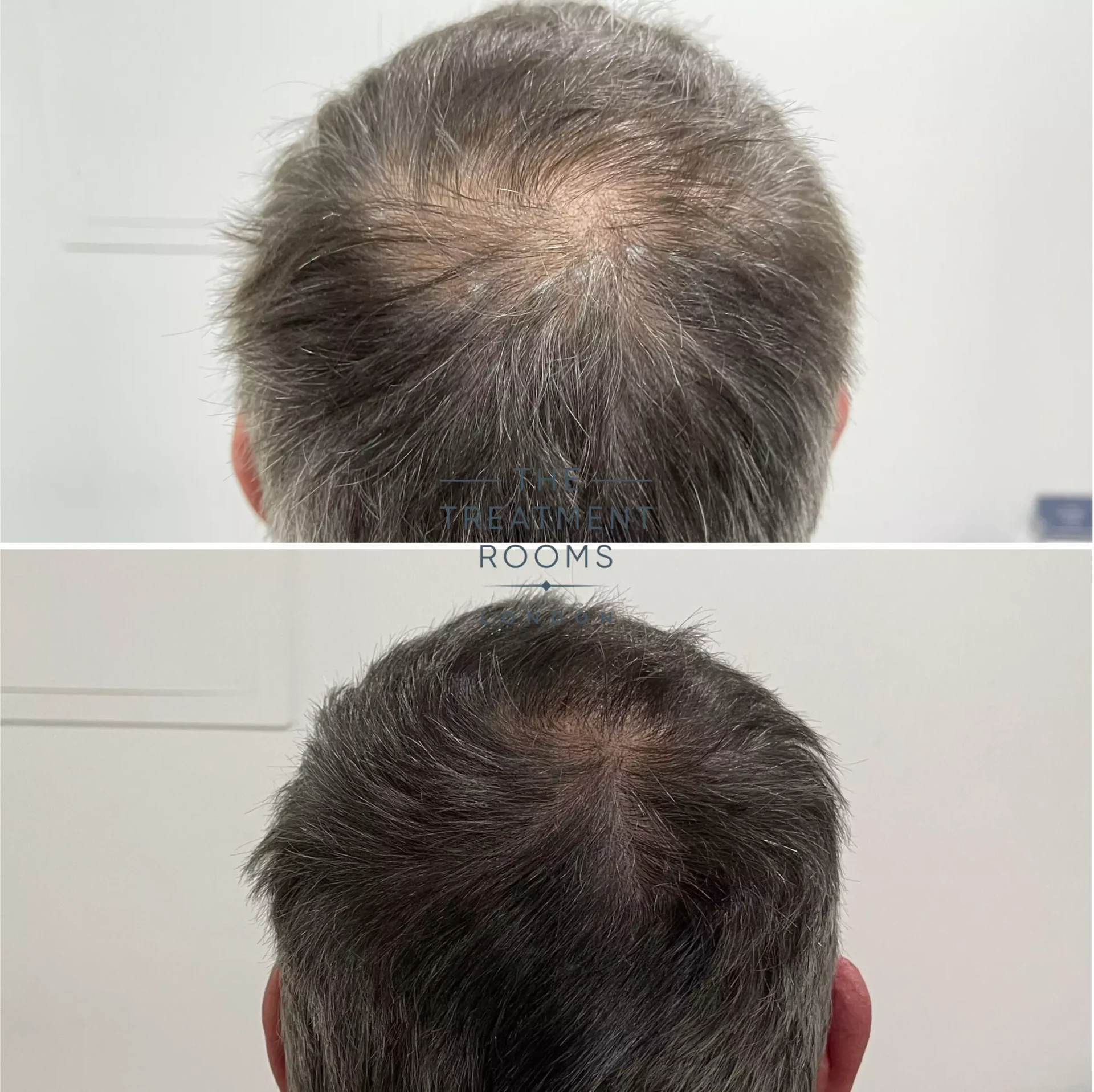 crown hair transplant before and after 597 grafts