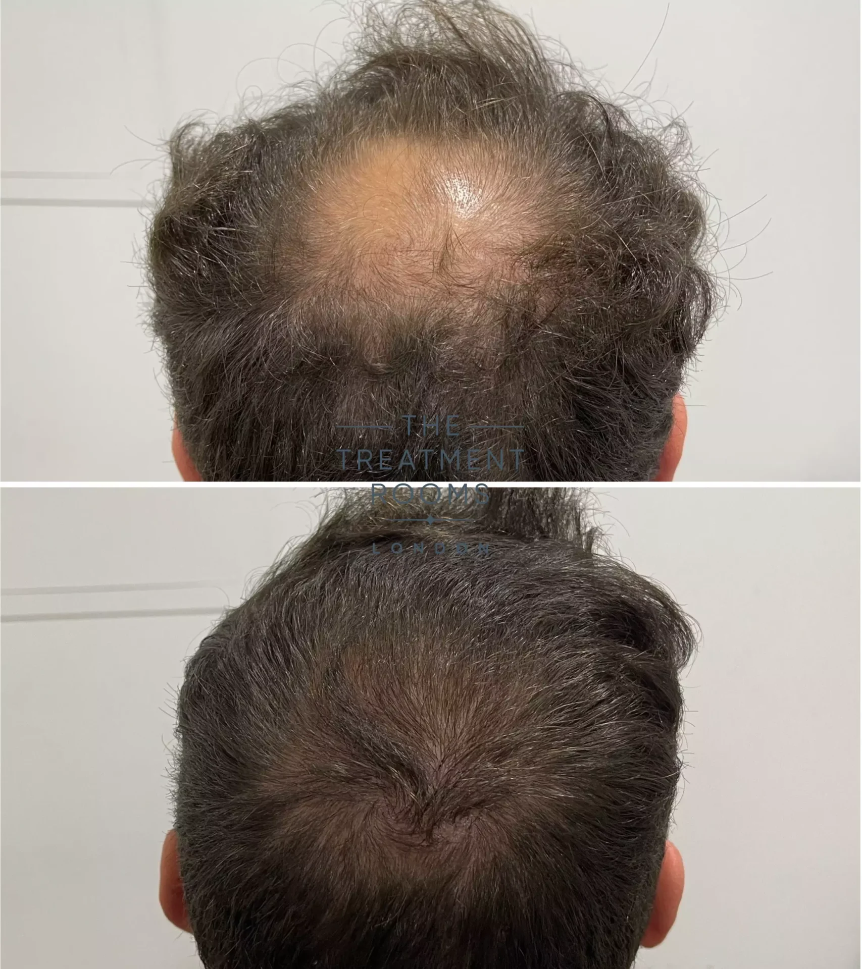 crown hair transplant before and after