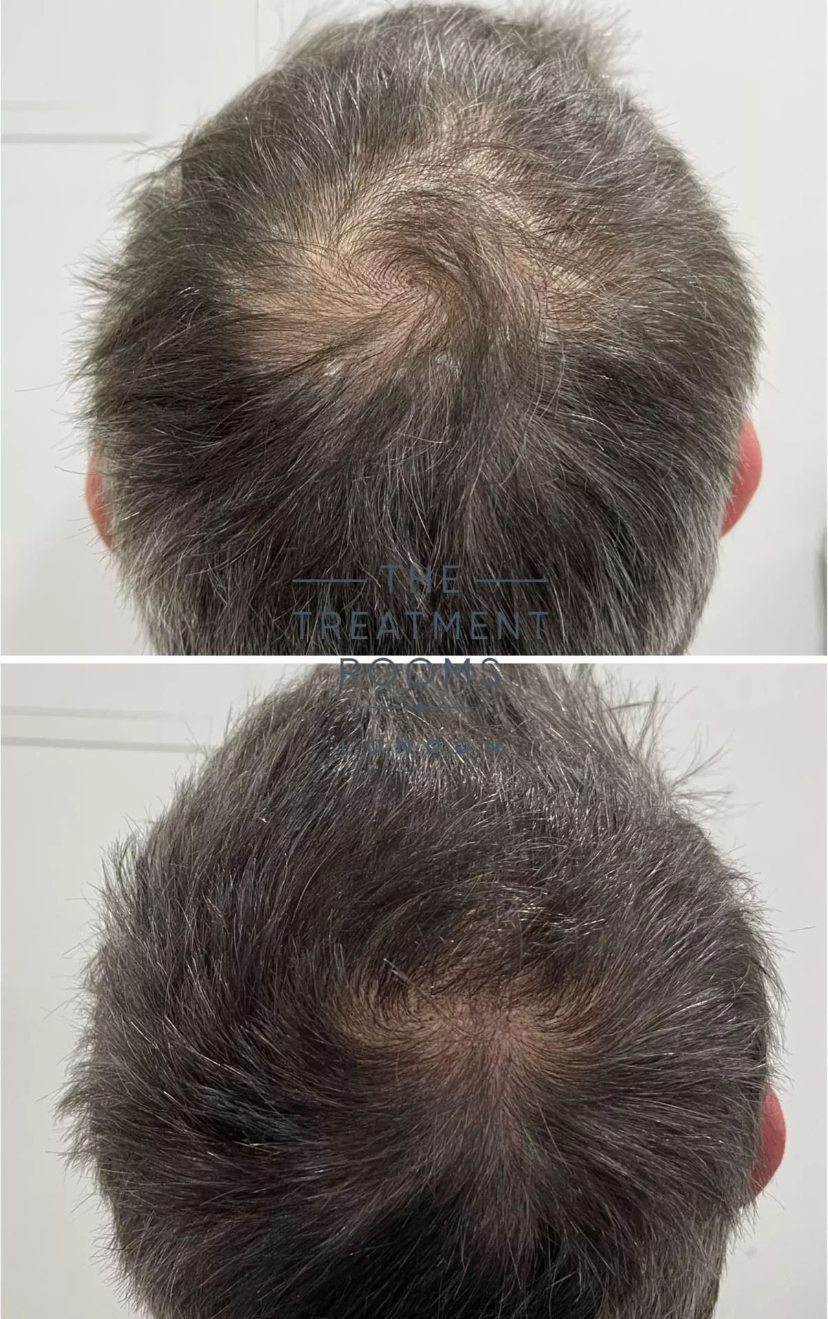 crown hair transplant clinic before and after 597 grafts