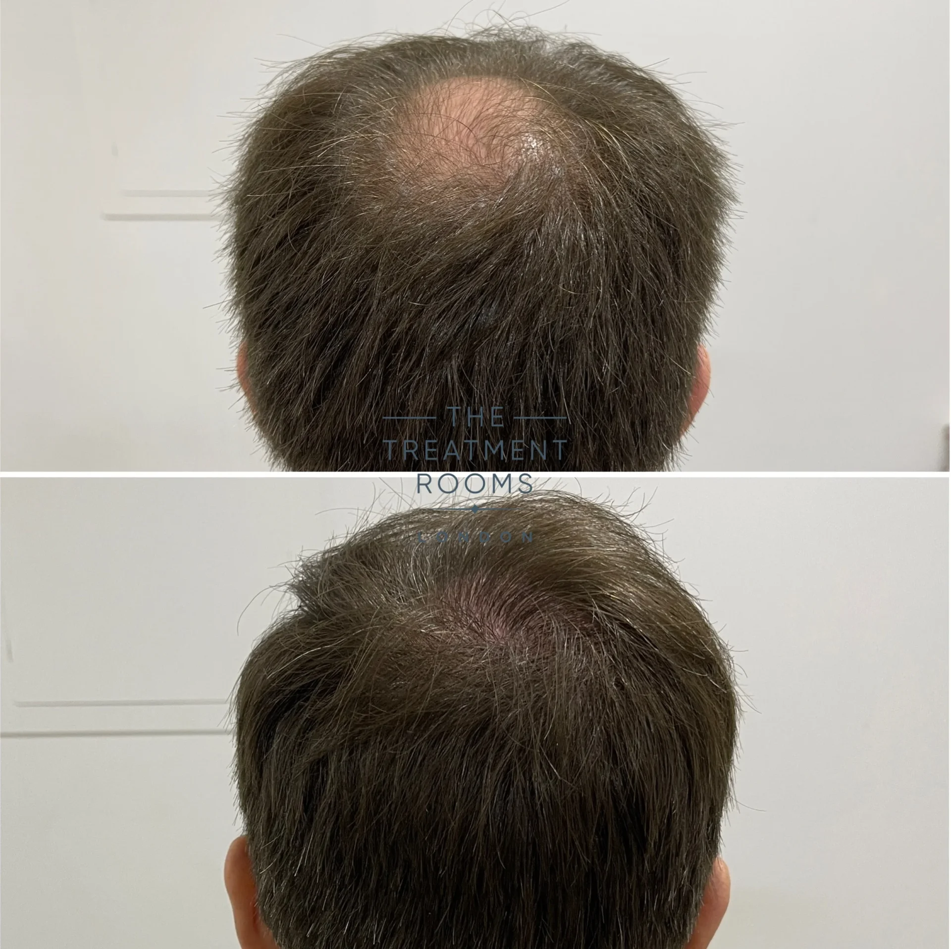 crown hair transplant lodnon 1485 grafts before and after