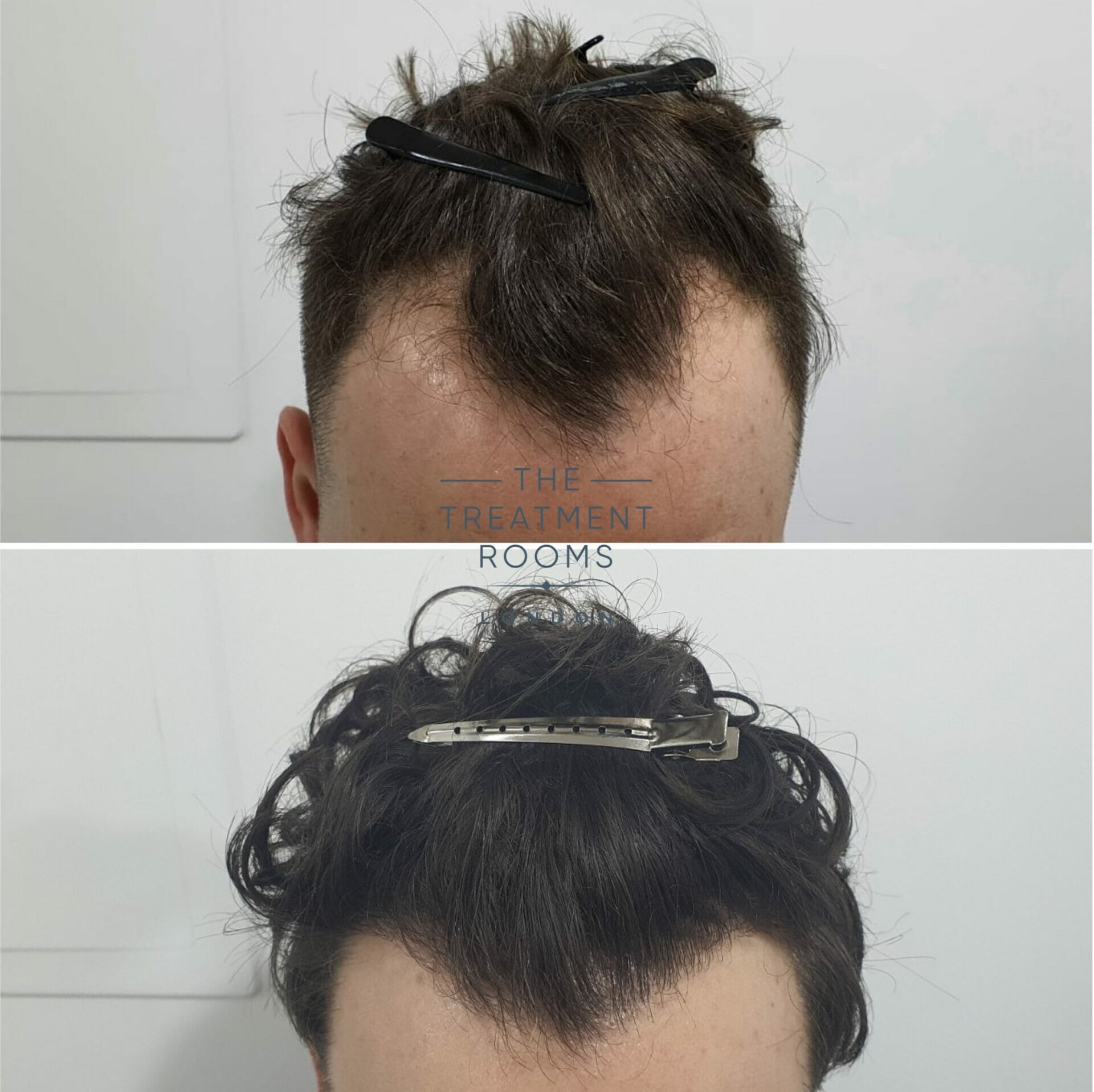 curly hair fue hair transplant before and after 1194 grafts hairline