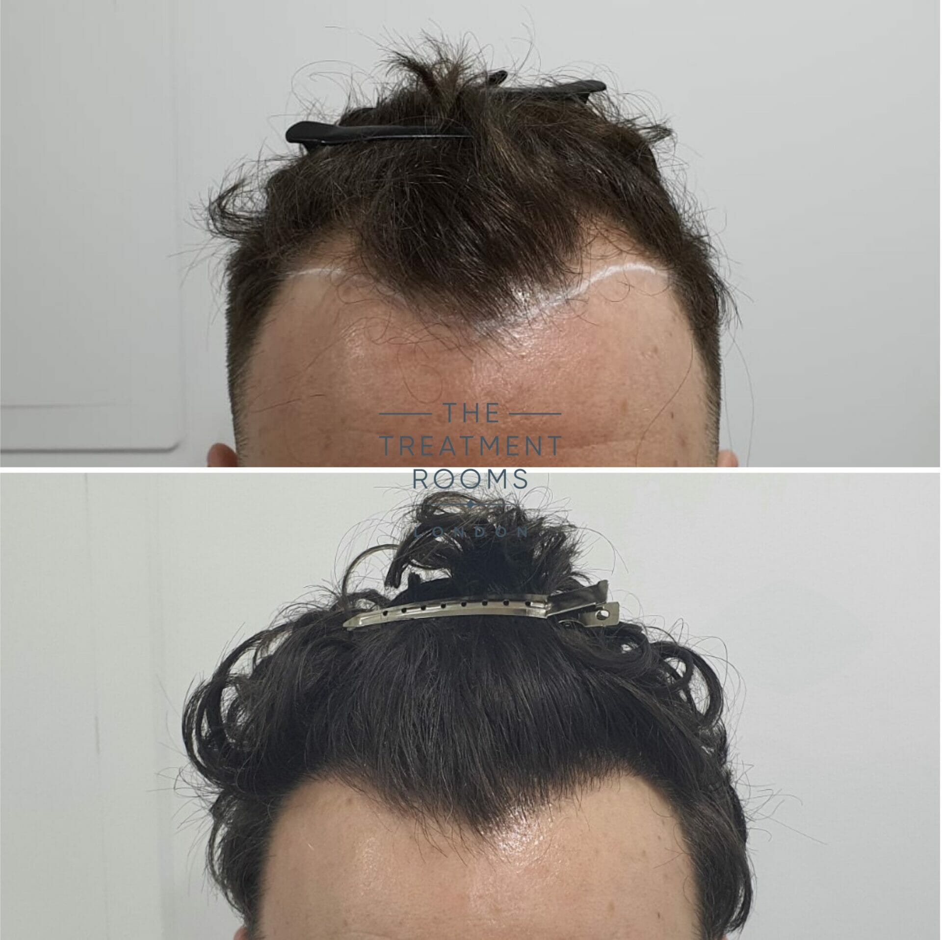 curly hair fue hair transplant before and after 1194 grafts