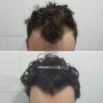 curly hair fue hair transplant before and after