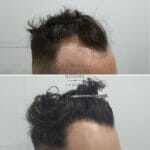 curly hair fue hair transplant before and after norwood 3