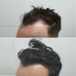 curly hair fue hair transplant before and after receding hairline