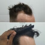curly hair temple fue hair transplant before and after