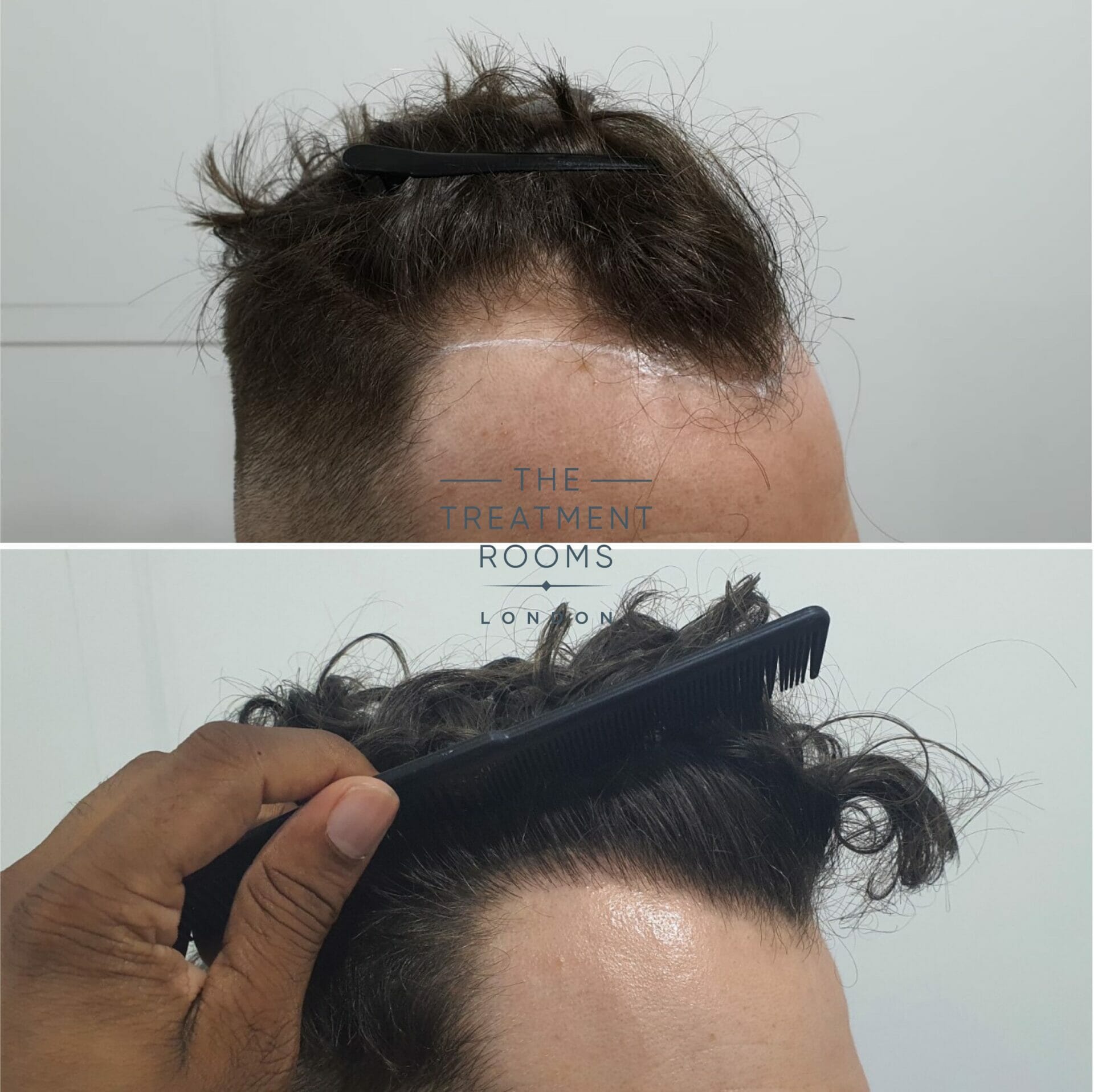 curly hair temple fue hair transplant before and after