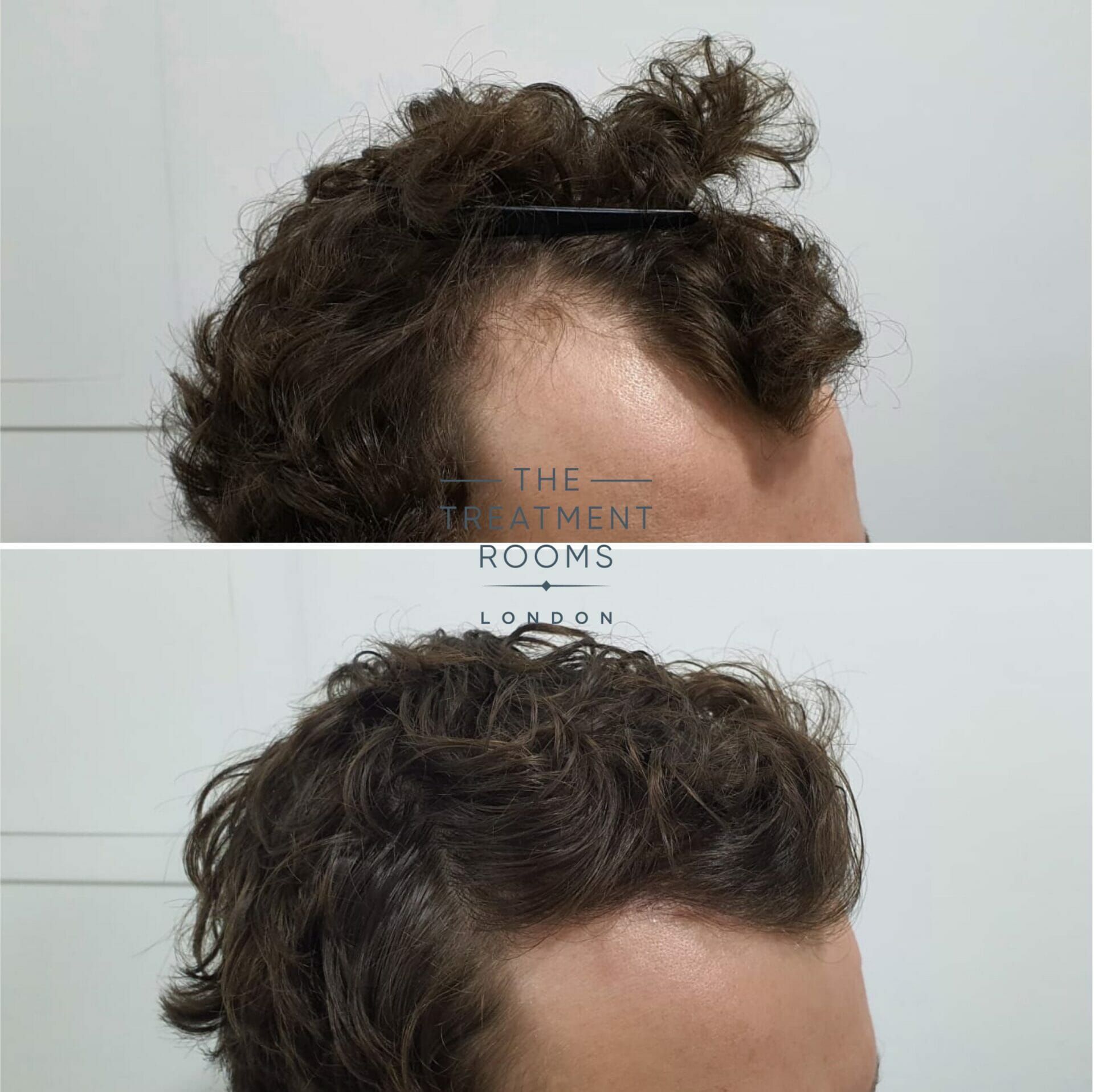 curly hair temple hair transplant 1243 grafts result