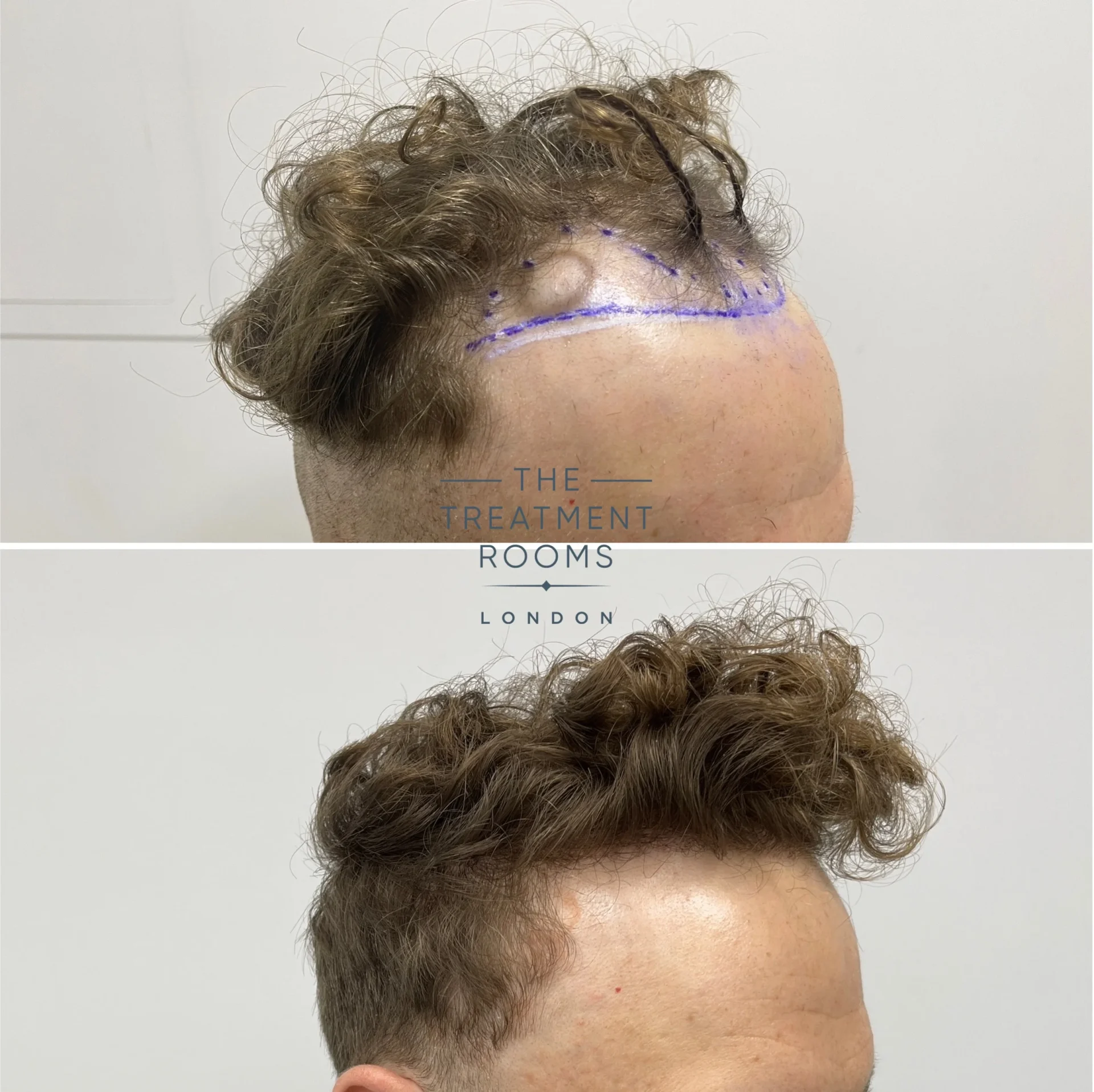 curly hair transplant london 1514 grafts before and after