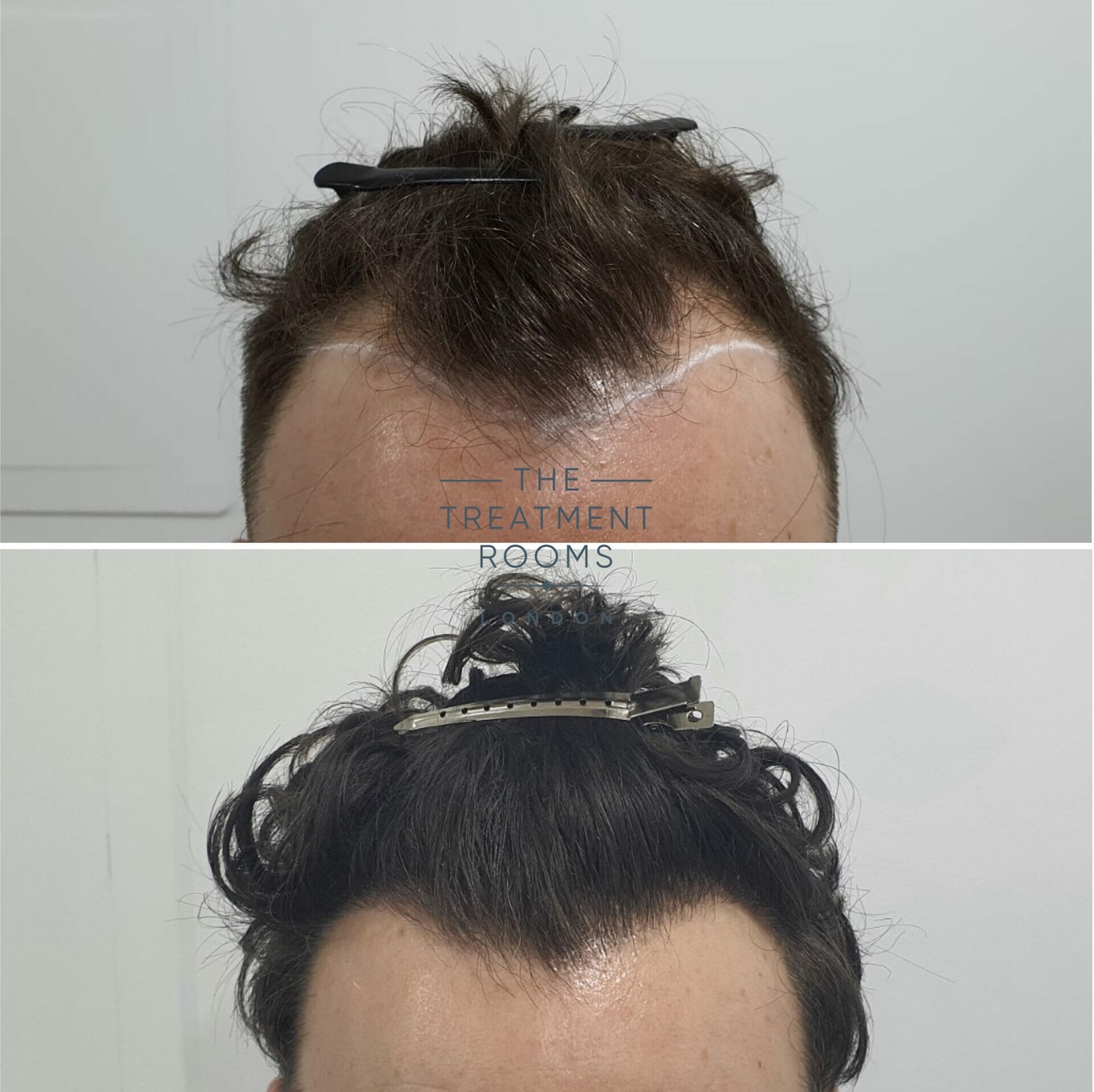 curly hair transplant result 1194 grafts