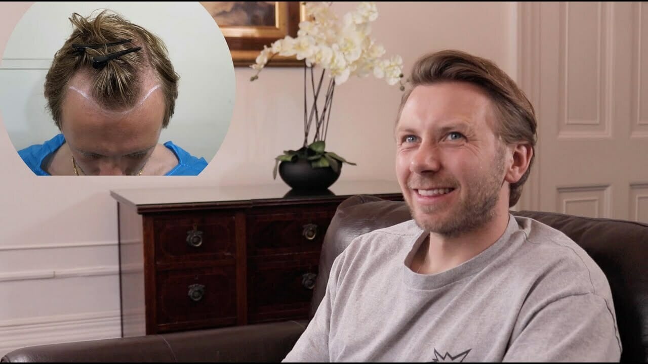 dans hair transplant result video thumbnail