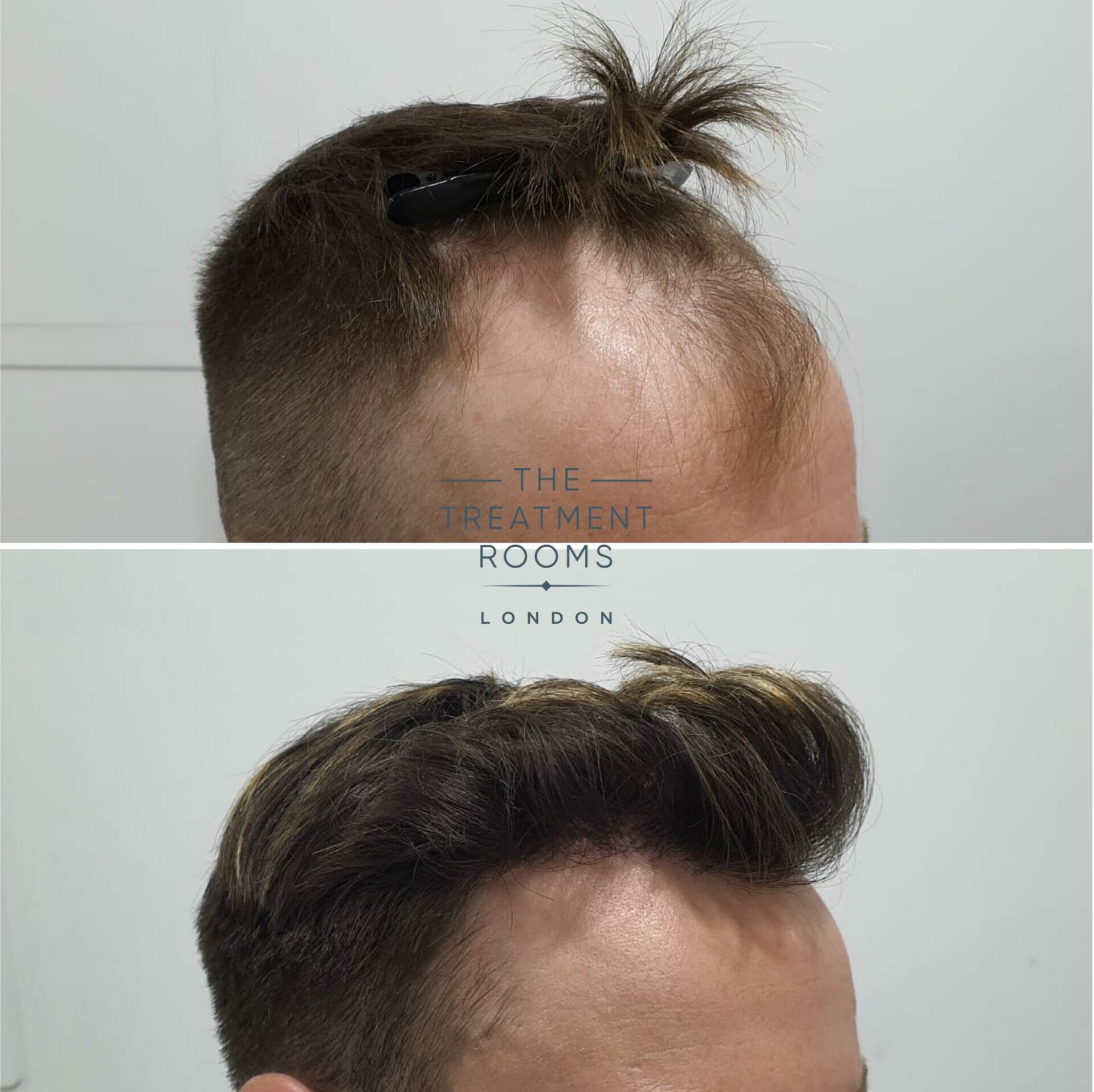 dhi hair transplant before and after 1724 grafts