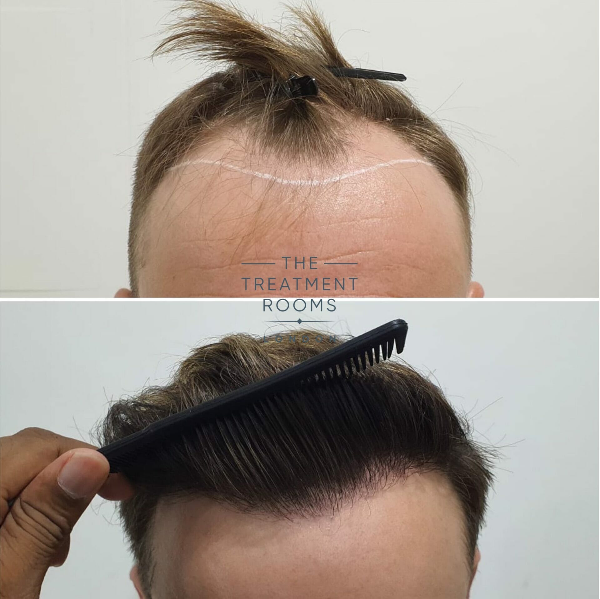 dhi hair transplant hairline before and after 1724 grafts