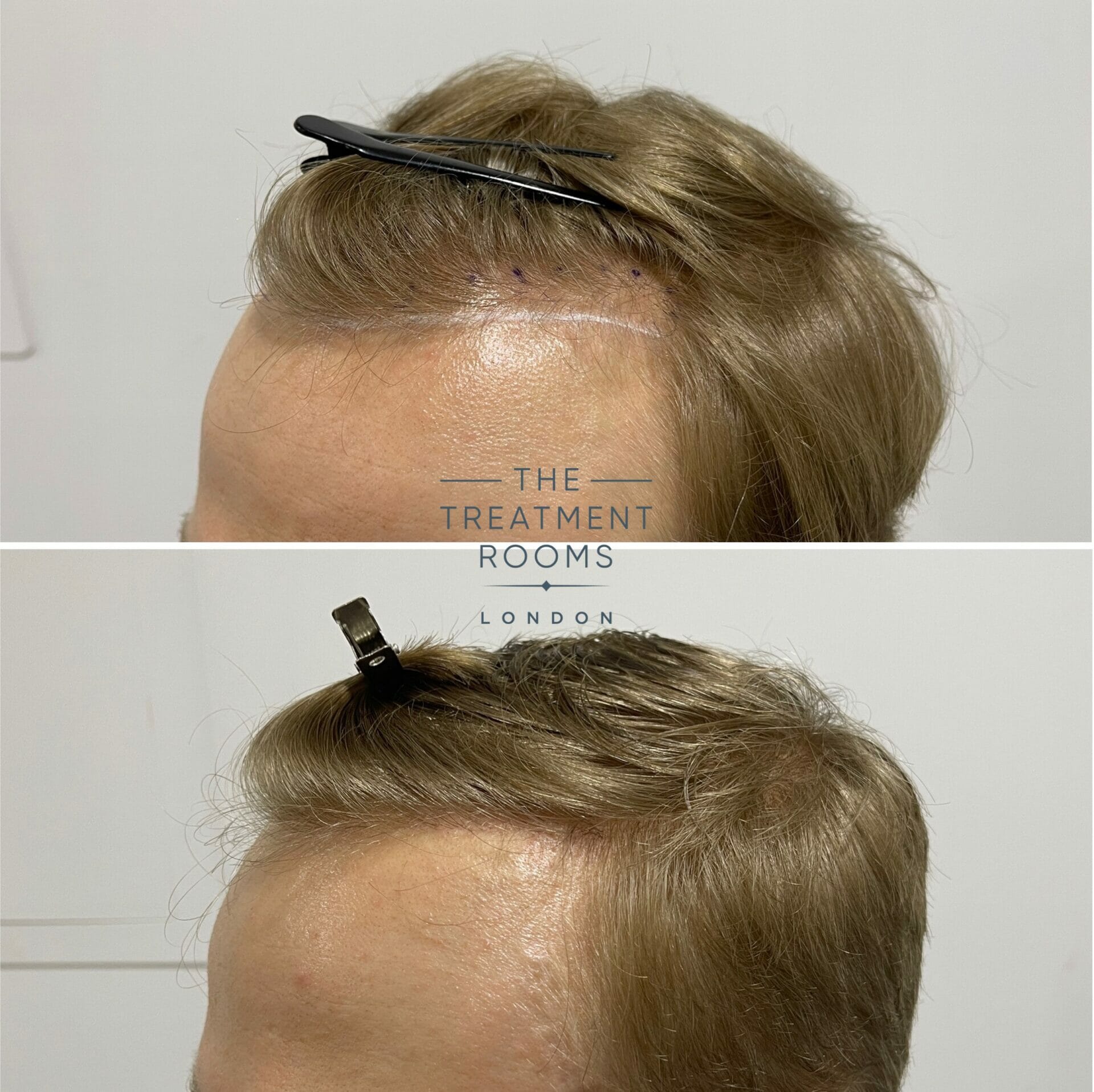 dhi hairline fue hair transplant 616 grafts