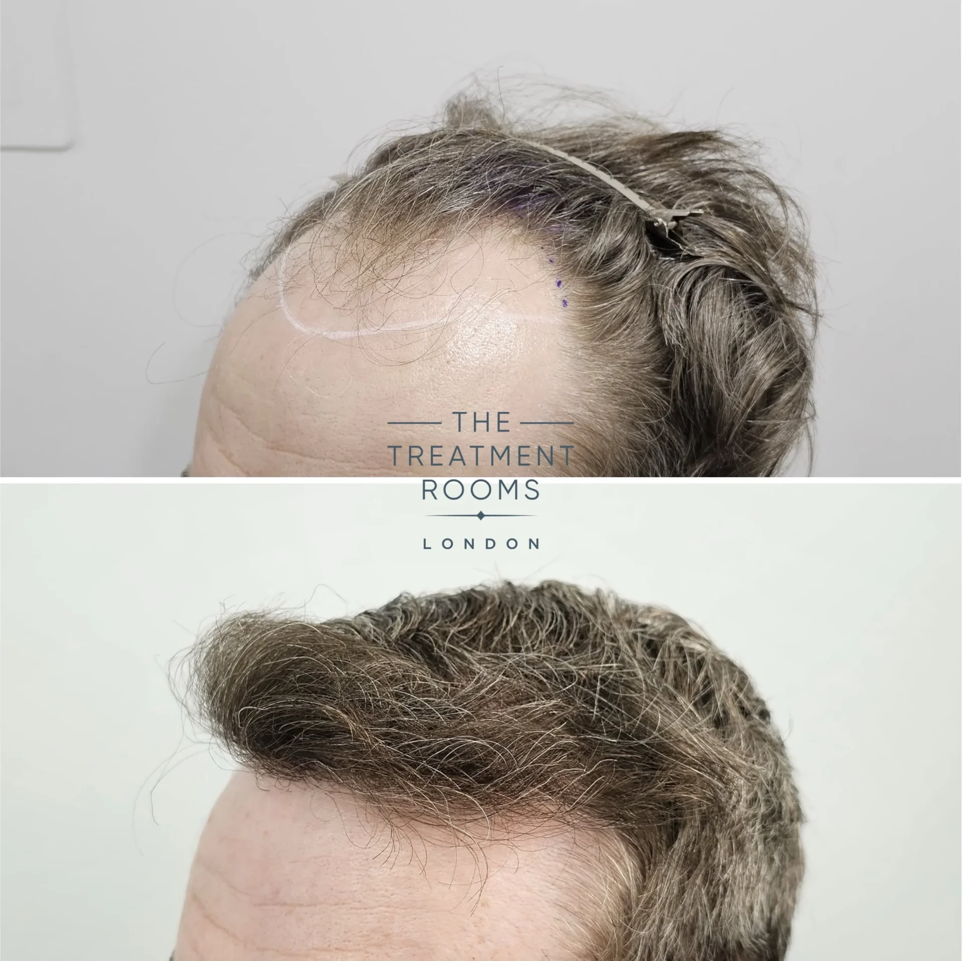 dhi transplant london before and after 2069 grafts dhi transplant london before and after 2069 grafts