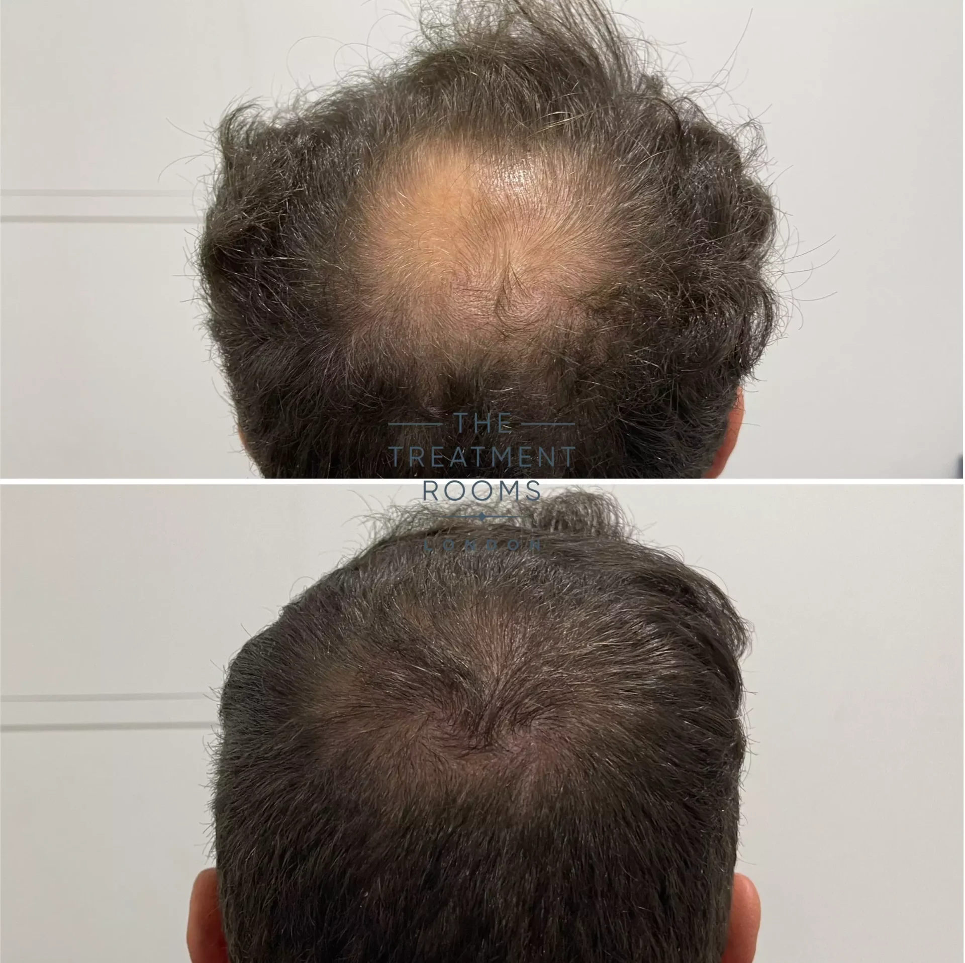 double spiral crown fue hair transplant before and after