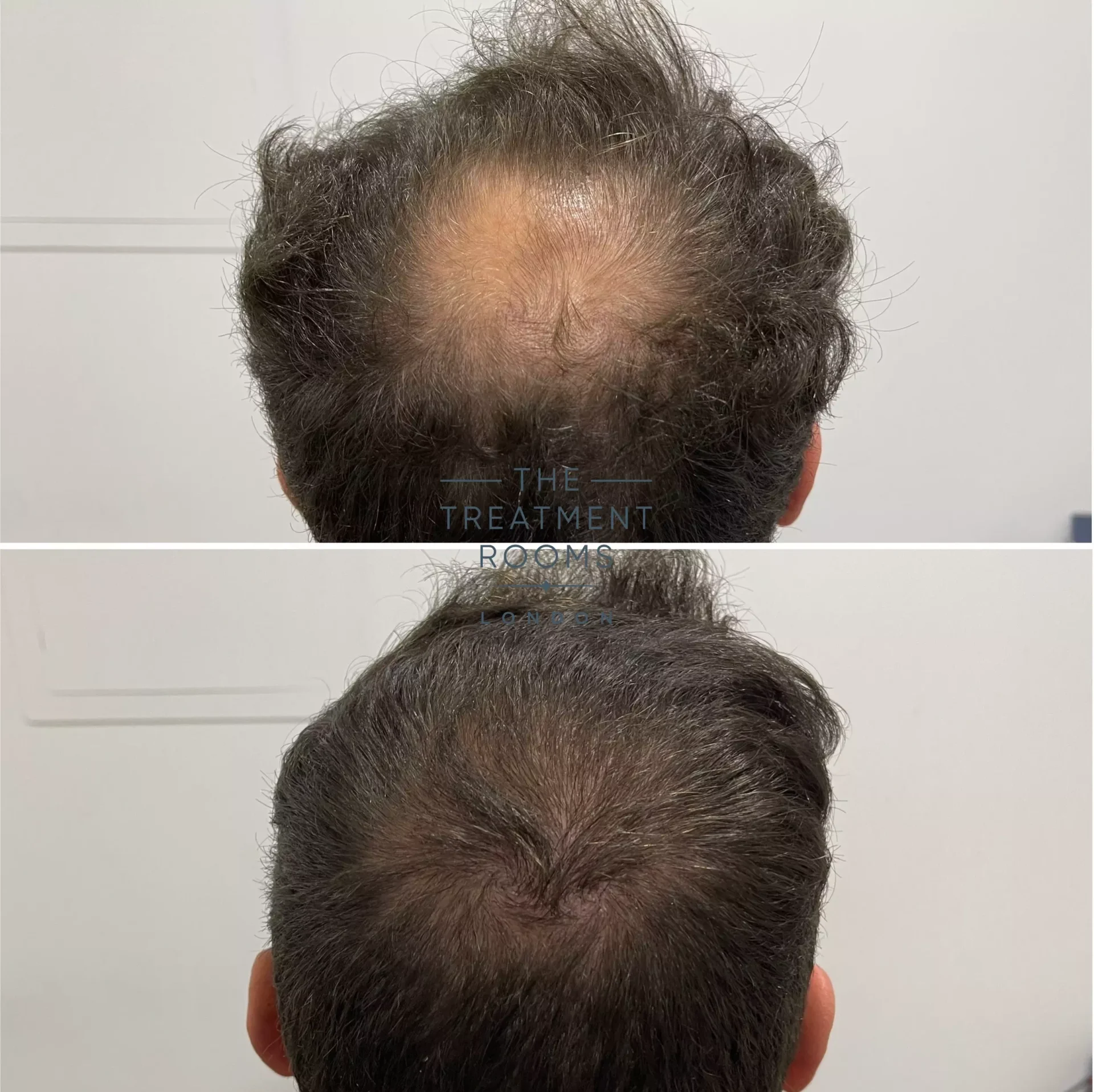 double spiral crown hair transplant before and after