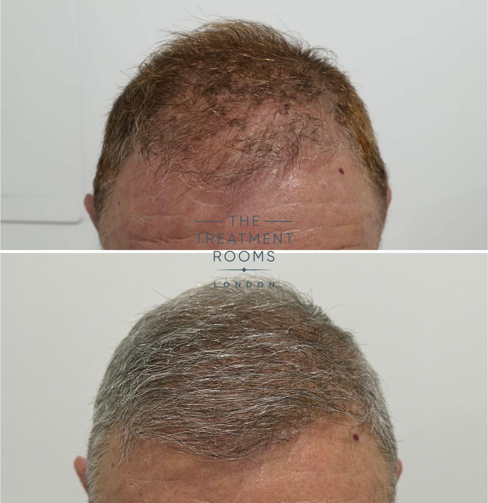 dye after hair transplant