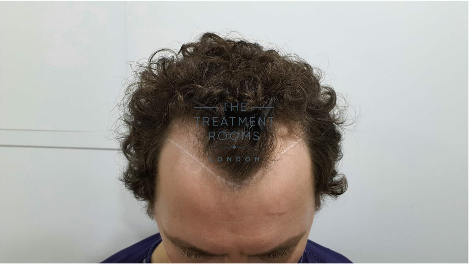 How Much a FUE Hair Transplant Costs in the UK | Treatment Rooms London