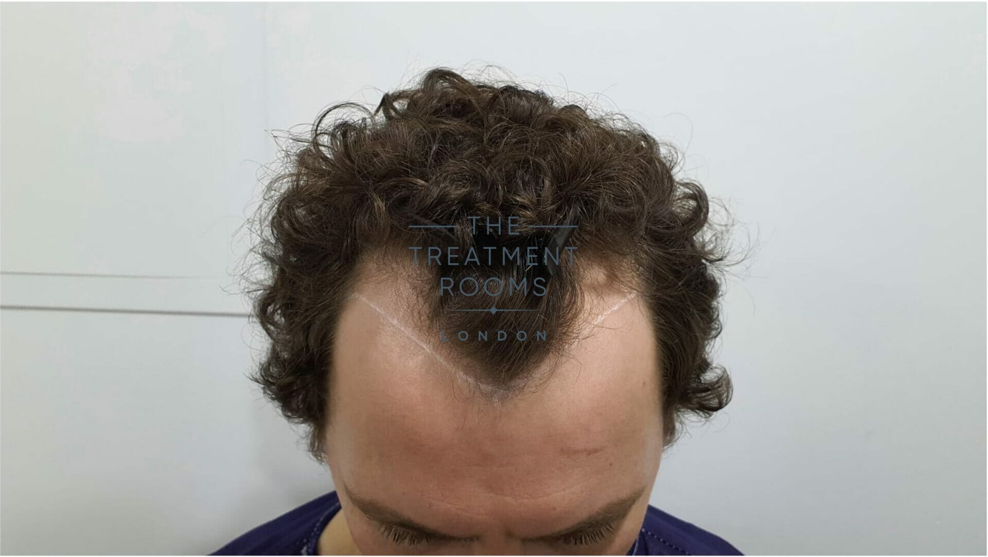 What Is A Widow s Peak The Treatment Rooms London
