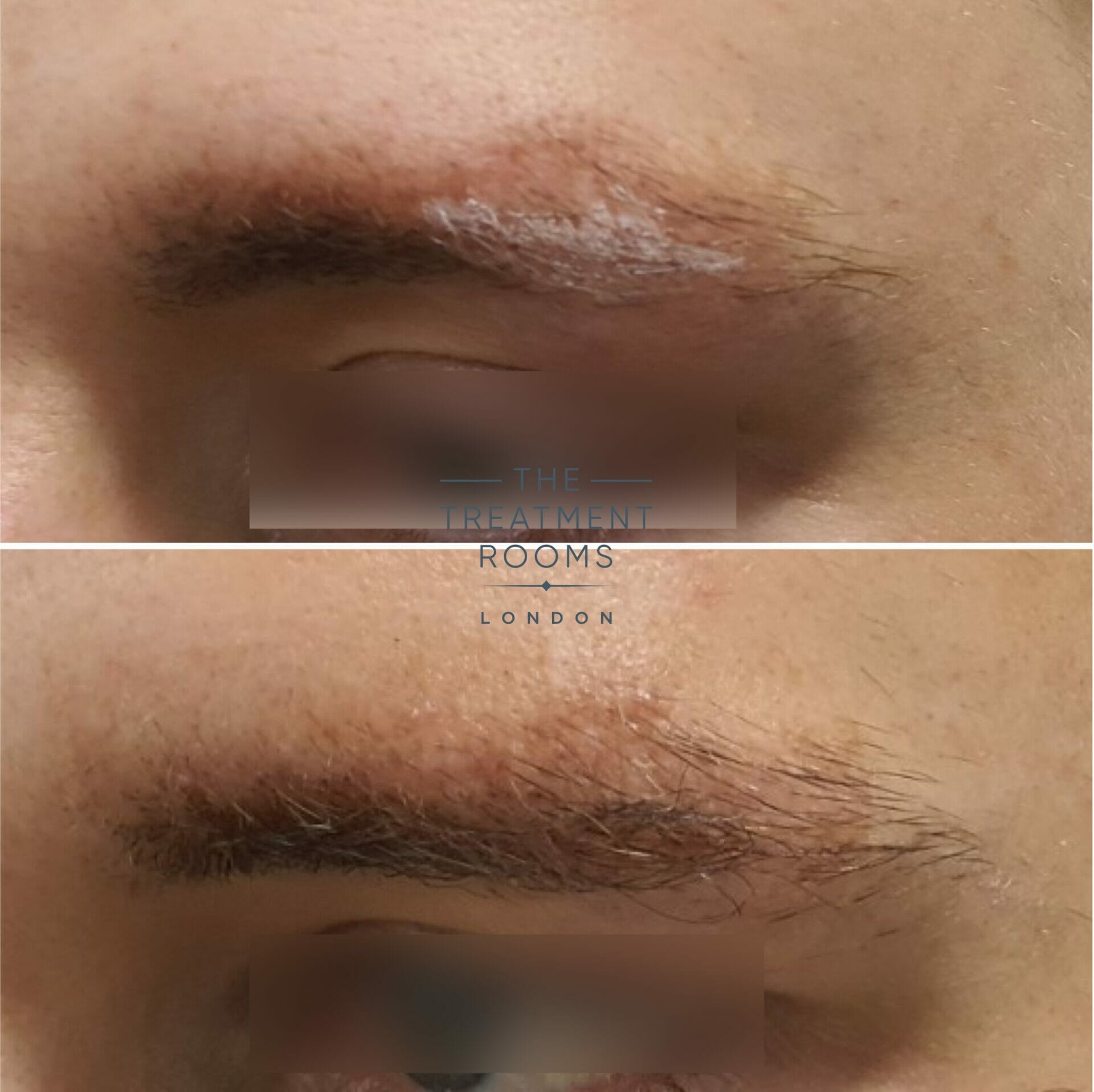 eyebrow fue hair transplant result