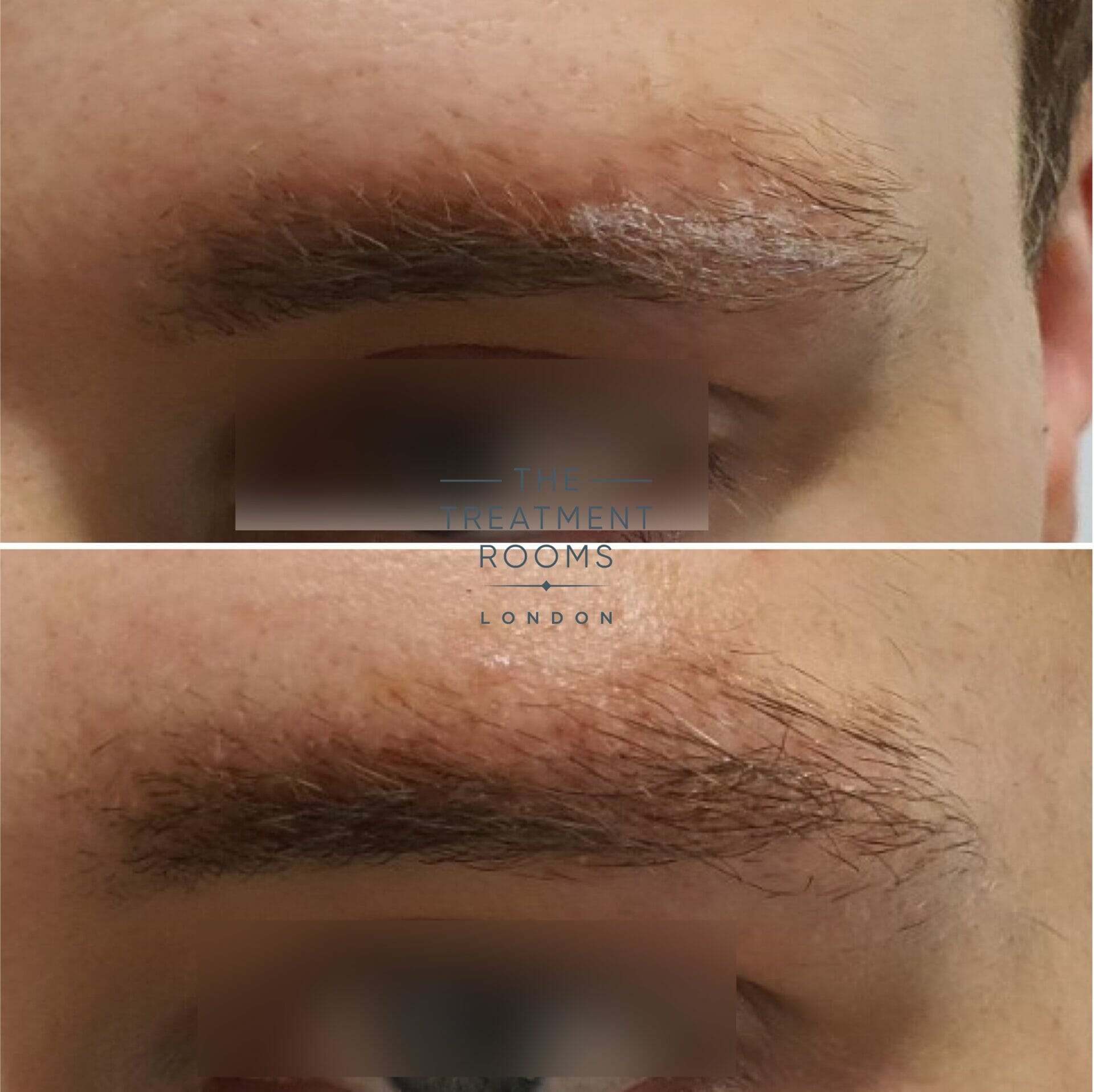 eyebrow hair transplant before and after